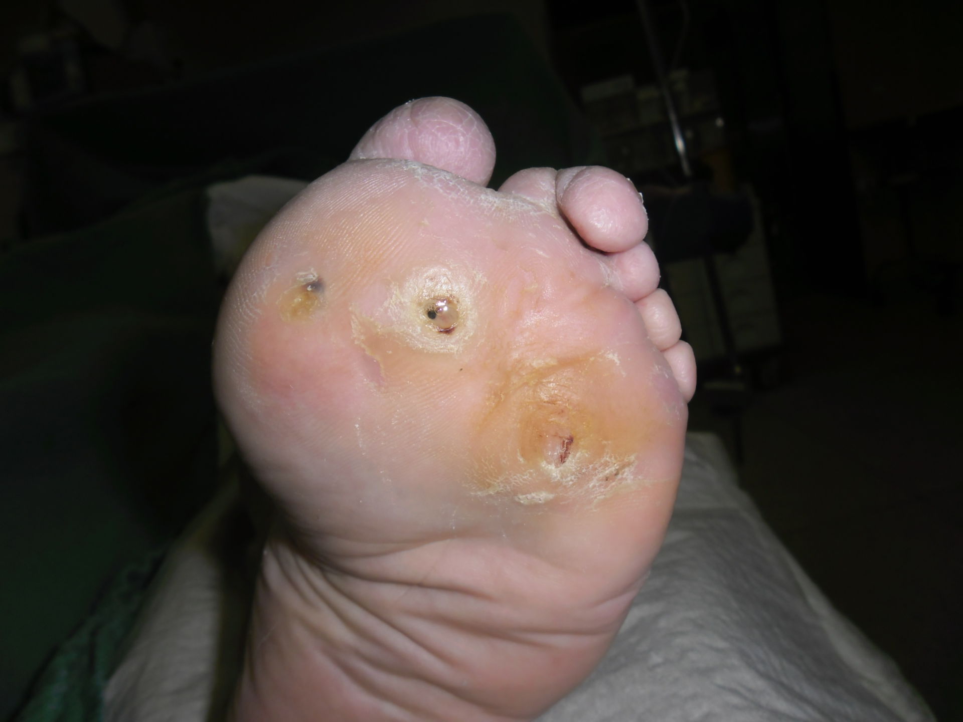 Male perforante dell'ulcera del piede diabetico