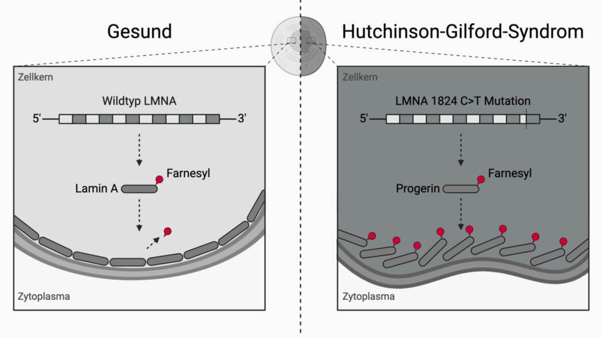 Hutchinson-Gilford-Syndrom