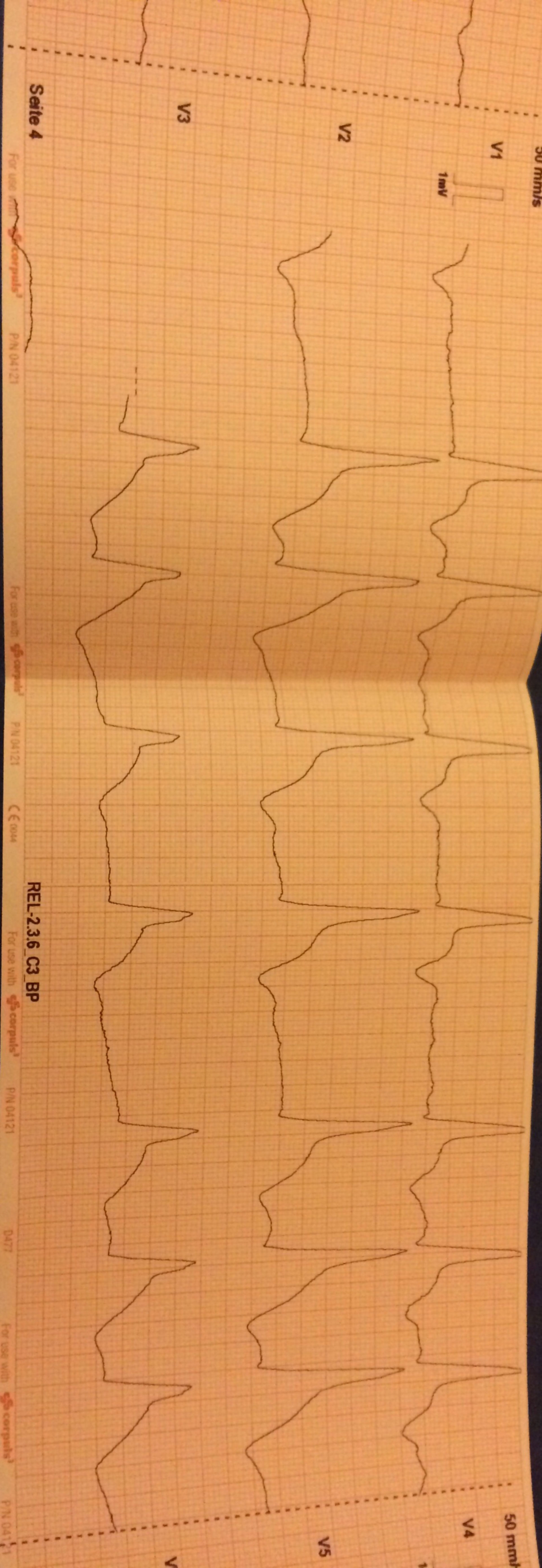 EKG Aufnahme einer 90-jährigen Patientin