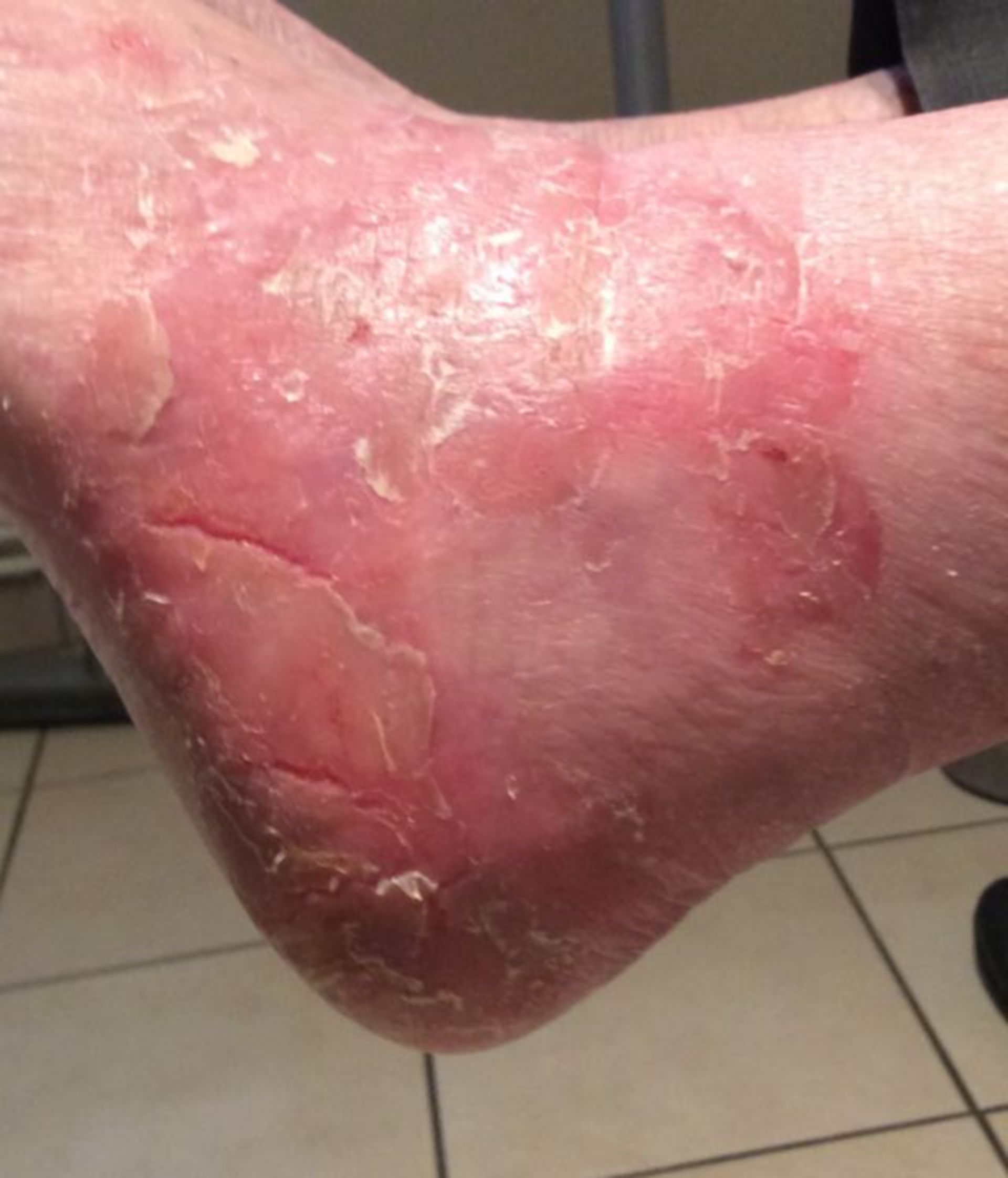 Eczema of the skin