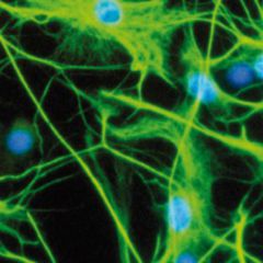 Chorea DocCheck Flexikon