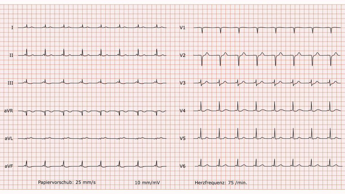 12-Kanal-EKG bei Lown-Ganong-Levine-Syndrom