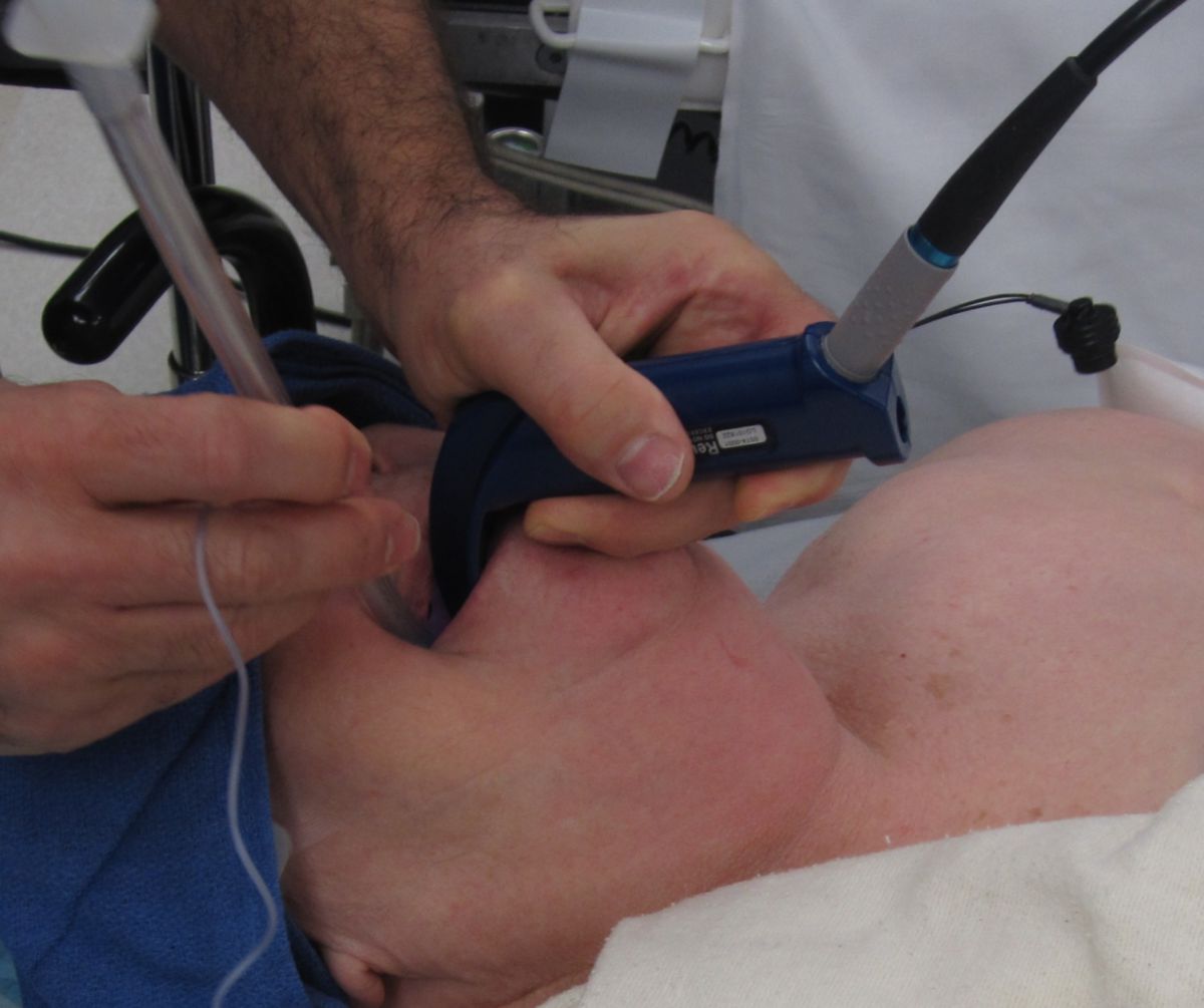 Intubation mit Video-Laryngoskop