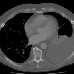 Hämatothorax DocCheck Flexikon