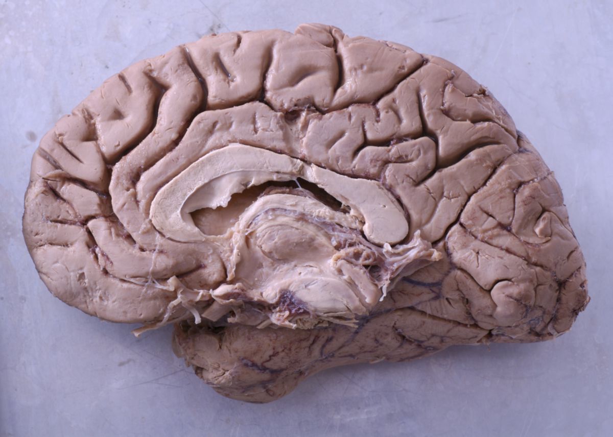 Gehirn (rechte Hemisphäre, Ansicht von medial)