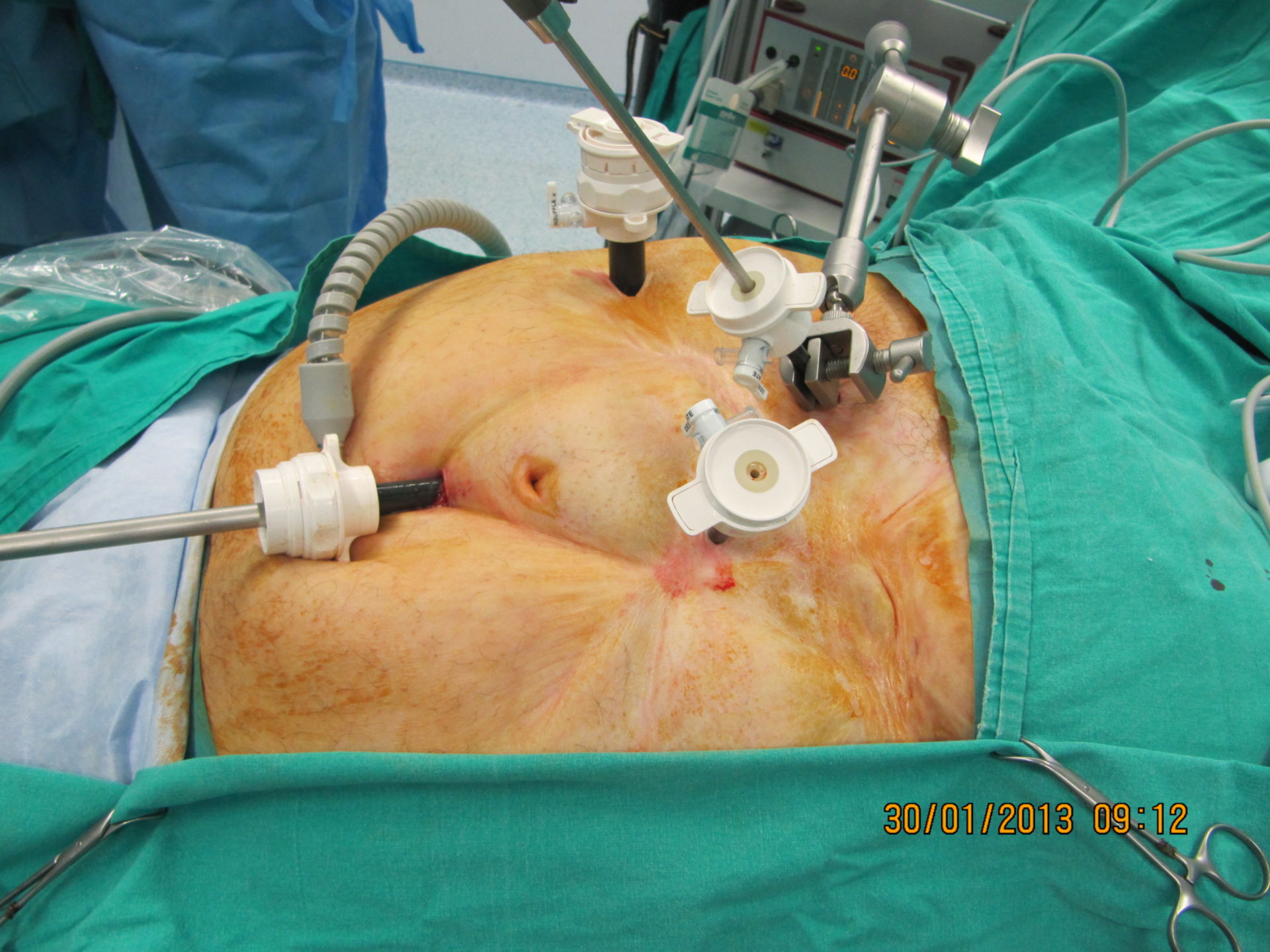 Inserimenti Trocar per la chirurgia bariatrica laparoscopica