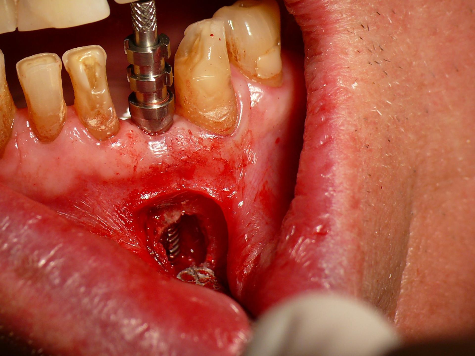 Fenestration of an implant in the jaw