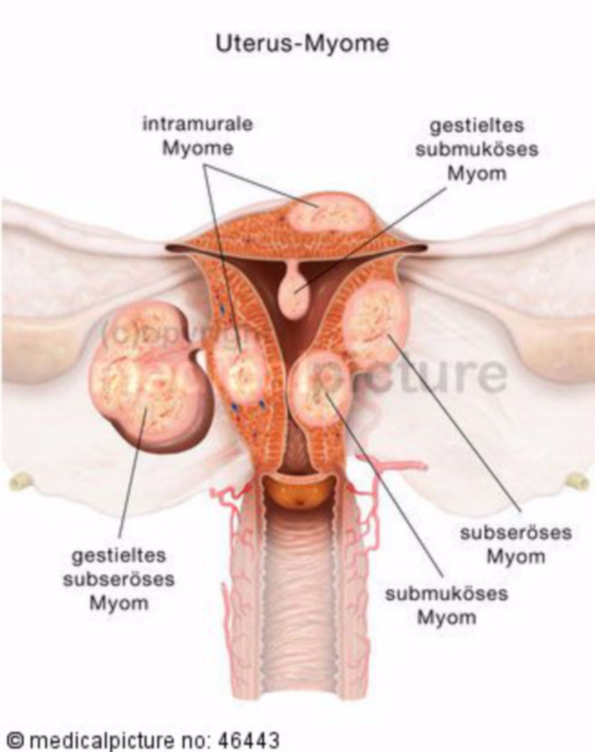 Arten von Uterus-Myomen