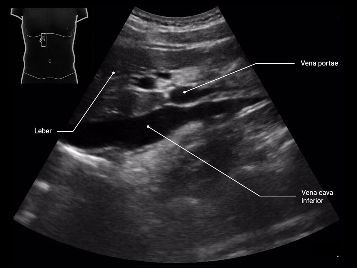 Vena cava inferior