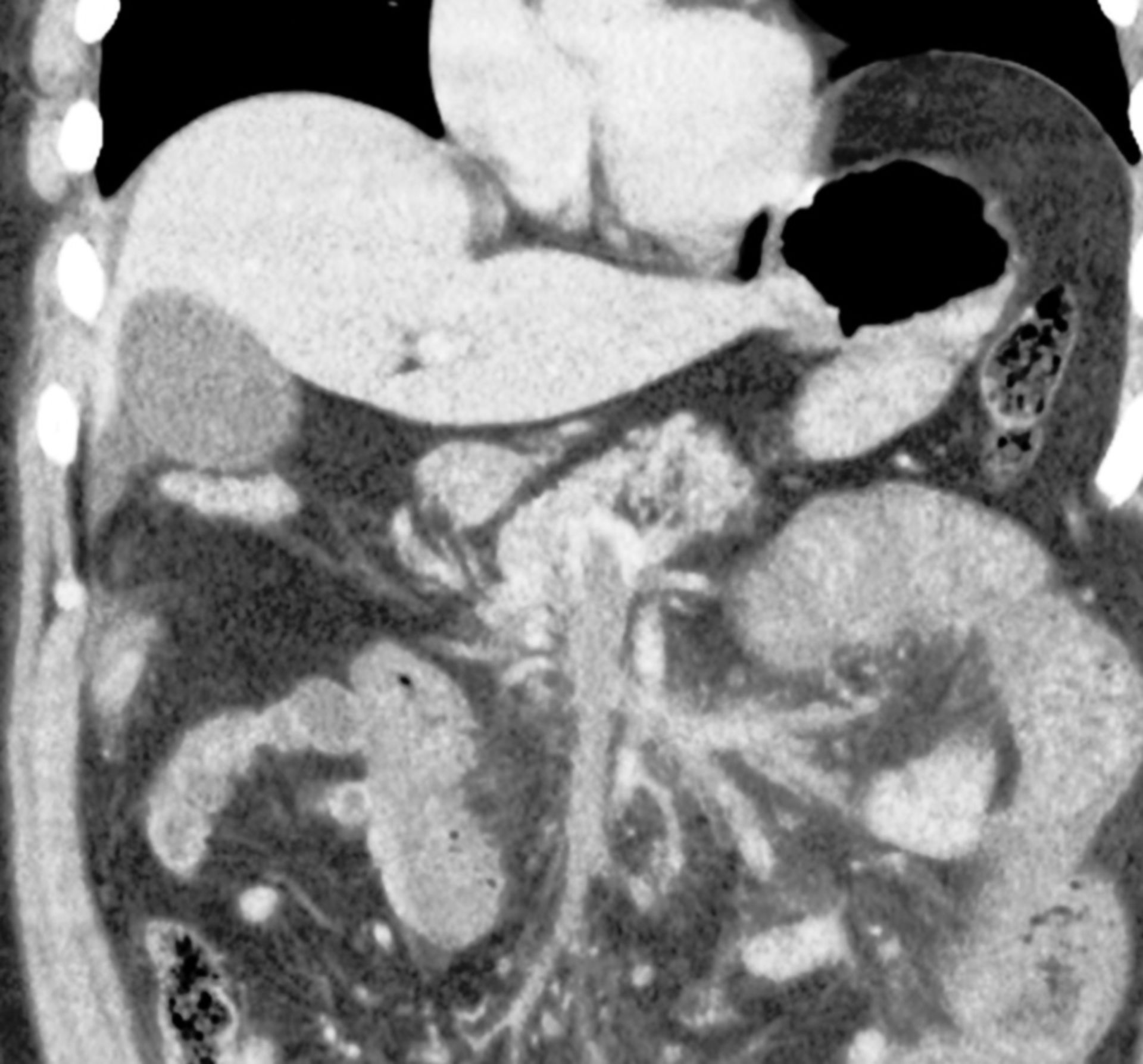 Mesenterialvenenthrombose