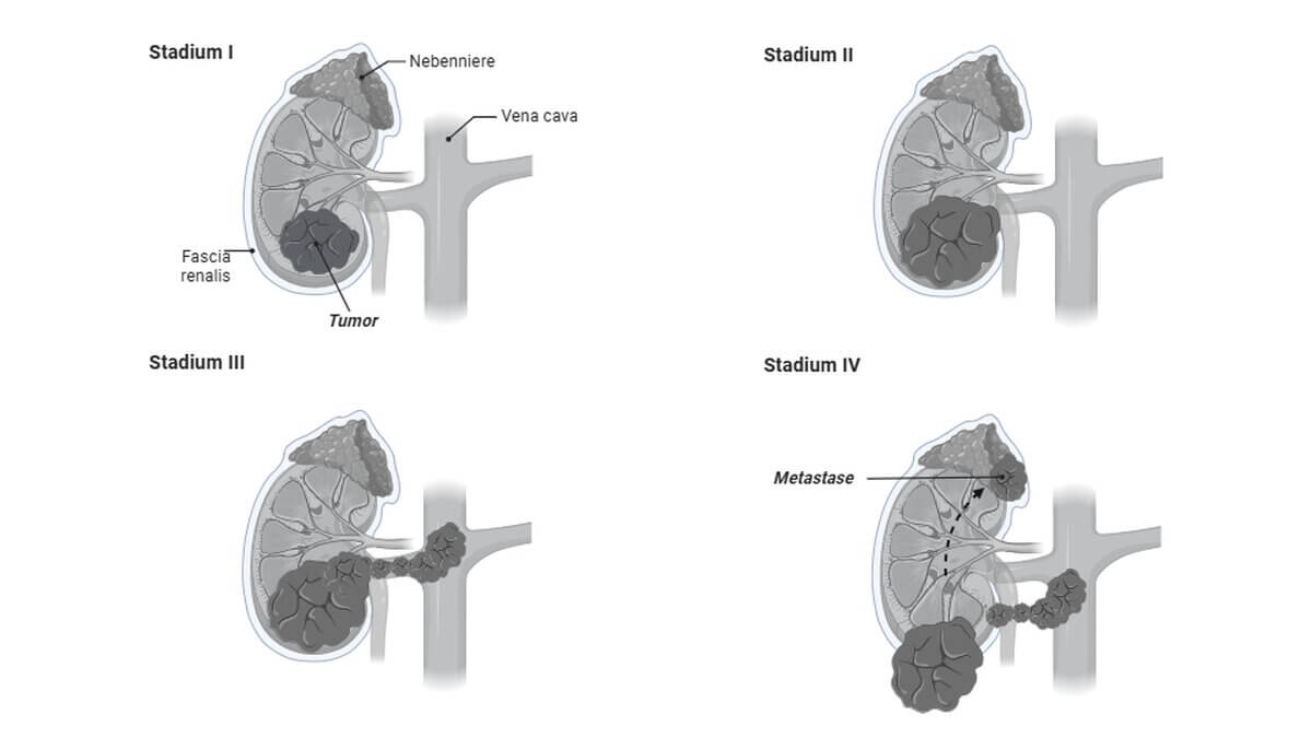 Schematische Darstellung der Tumorstadien eines RCC