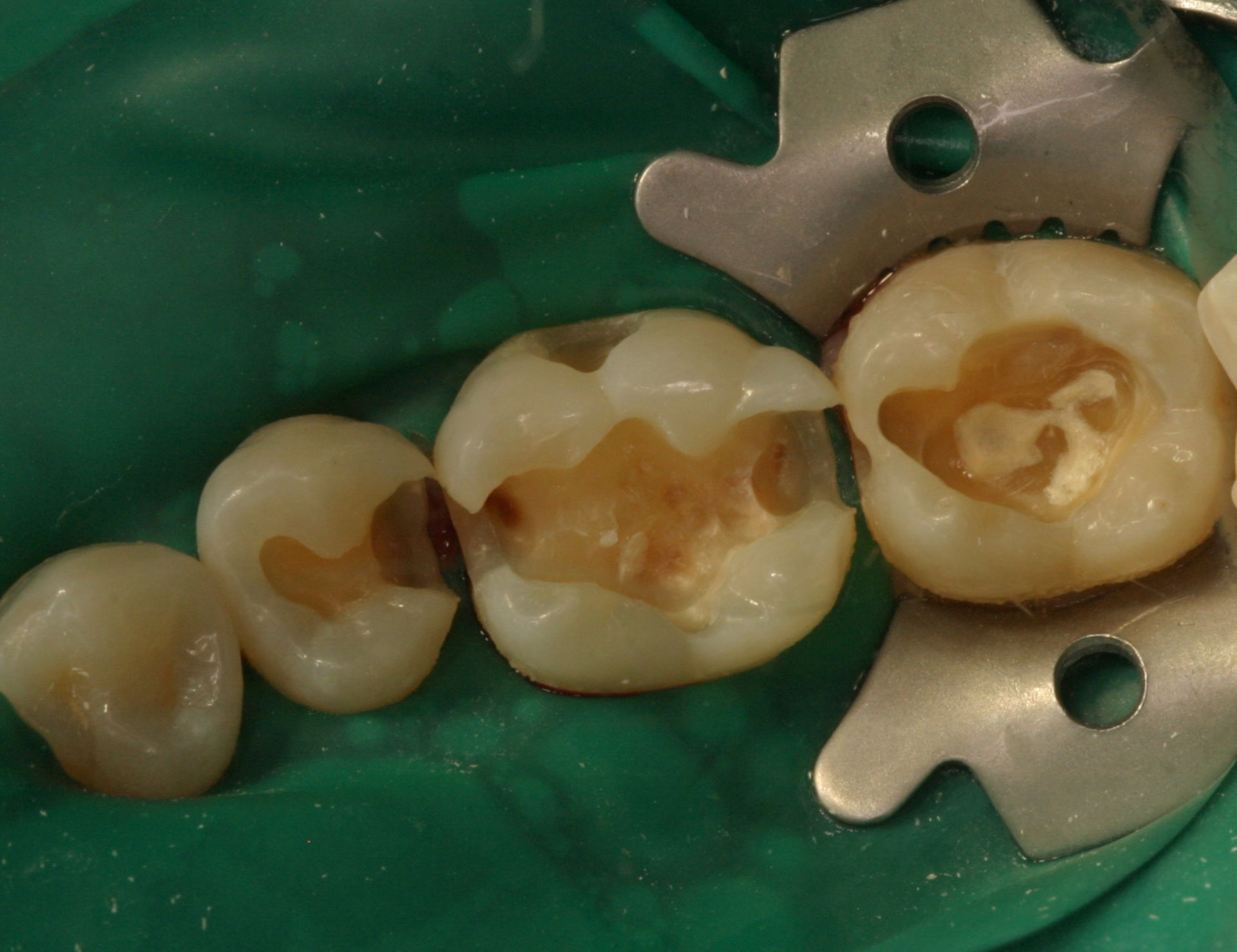 Teeth 45-47 after removal of the insufficient fillings, before excavation