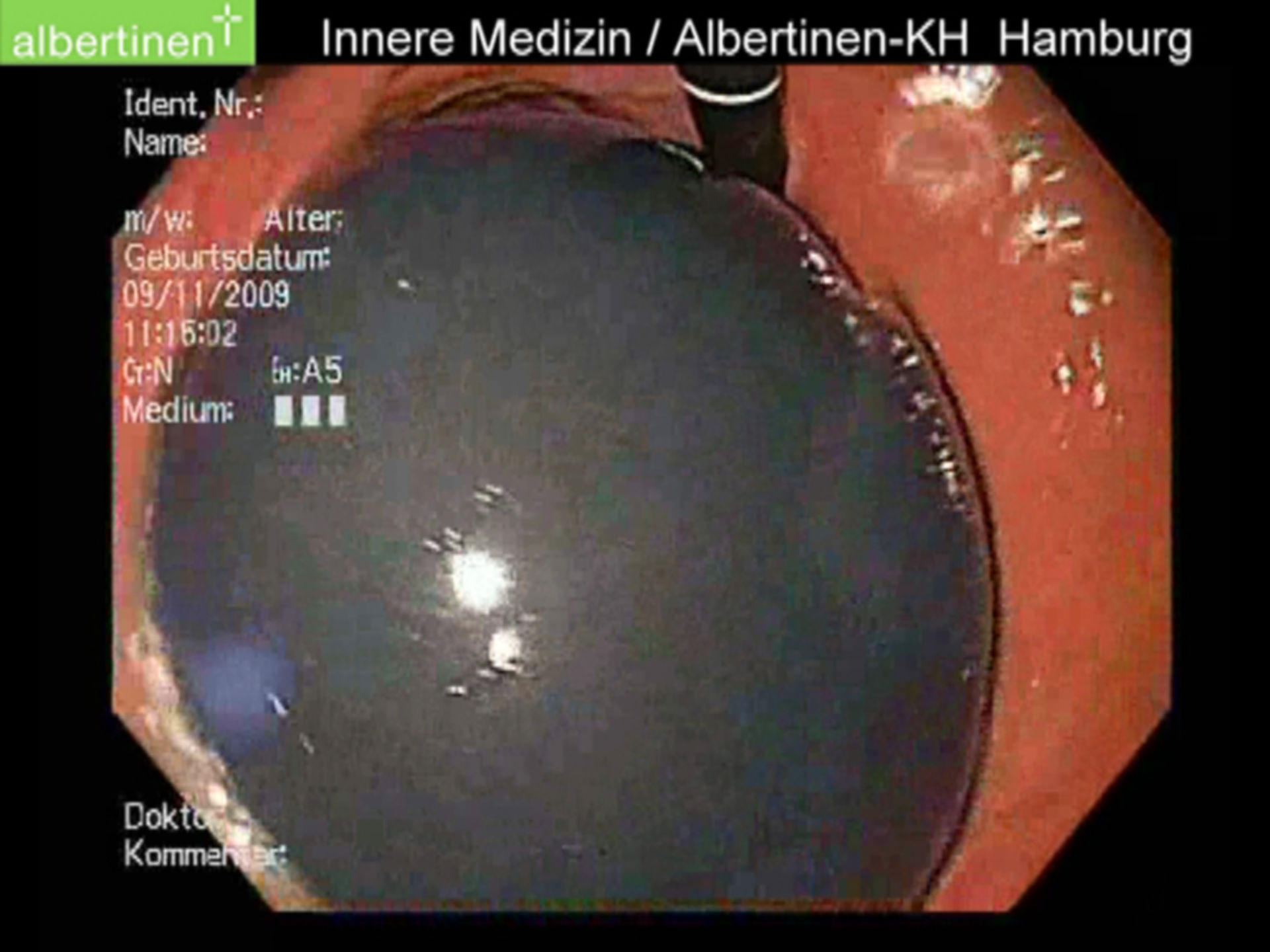 Gastric balloon