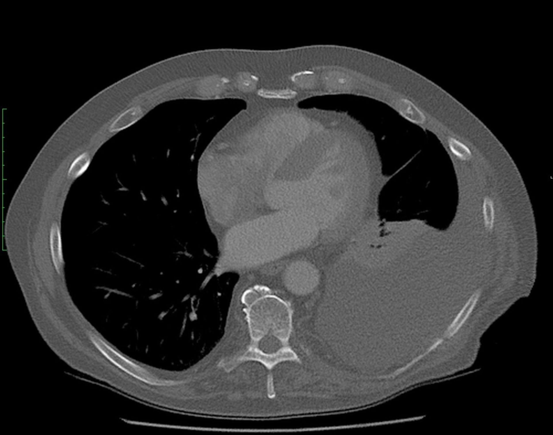 CT von Lungenverletzung mit Hämatothorax