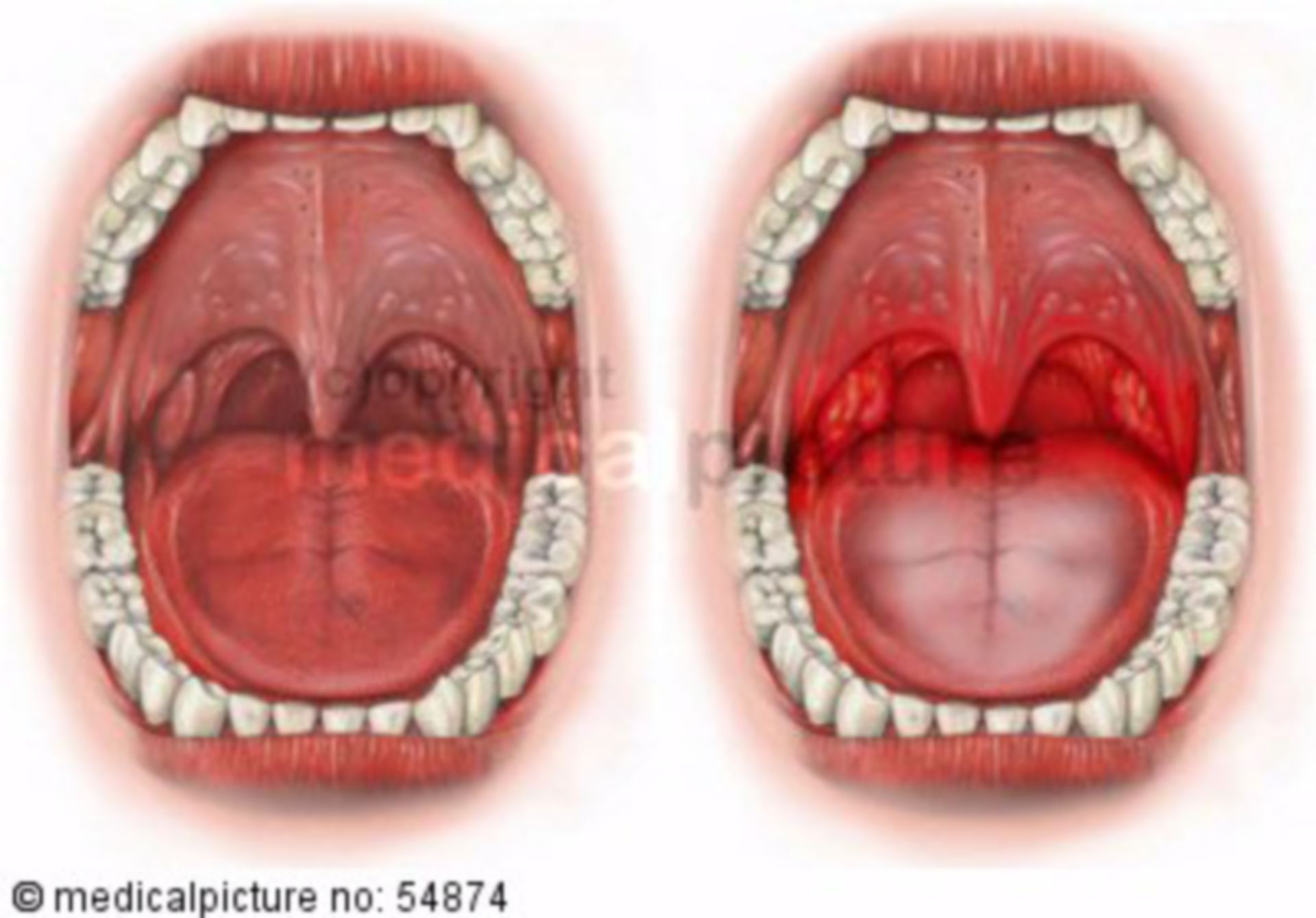 Angina tonsillaris