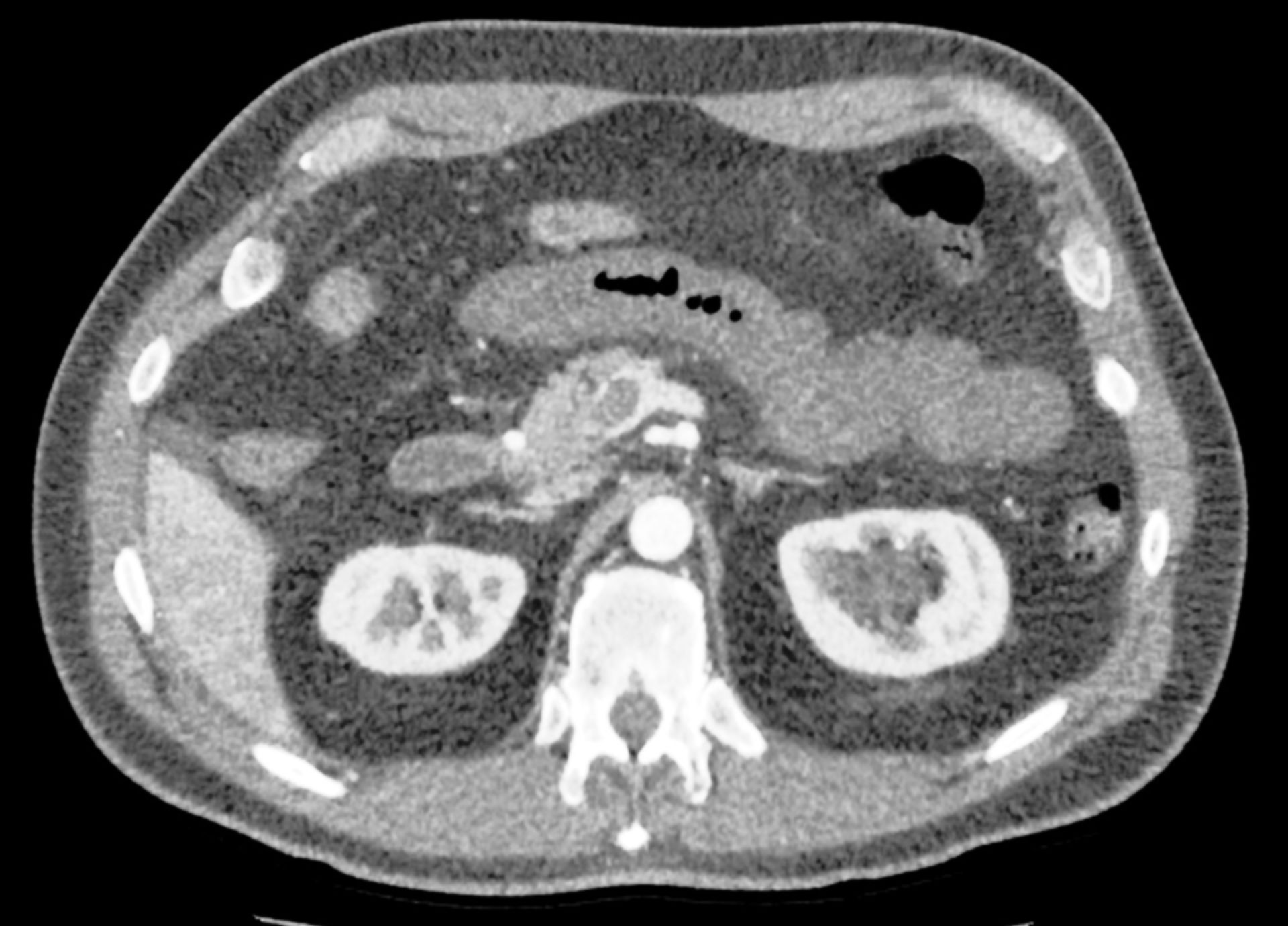 CT des Abdomens in transversaler Ebene mit Mesenterialvenenthrombose