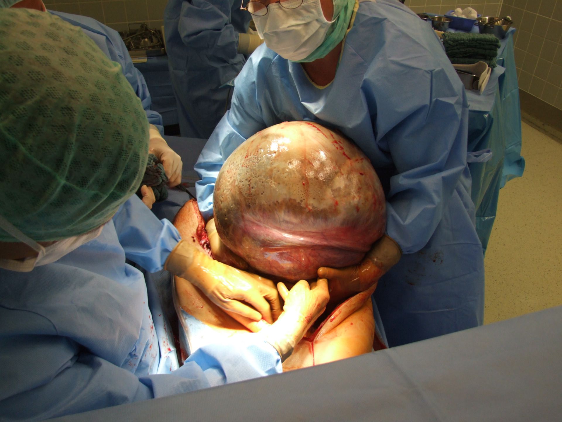 Tumor de ovario (24kg/53lbs)