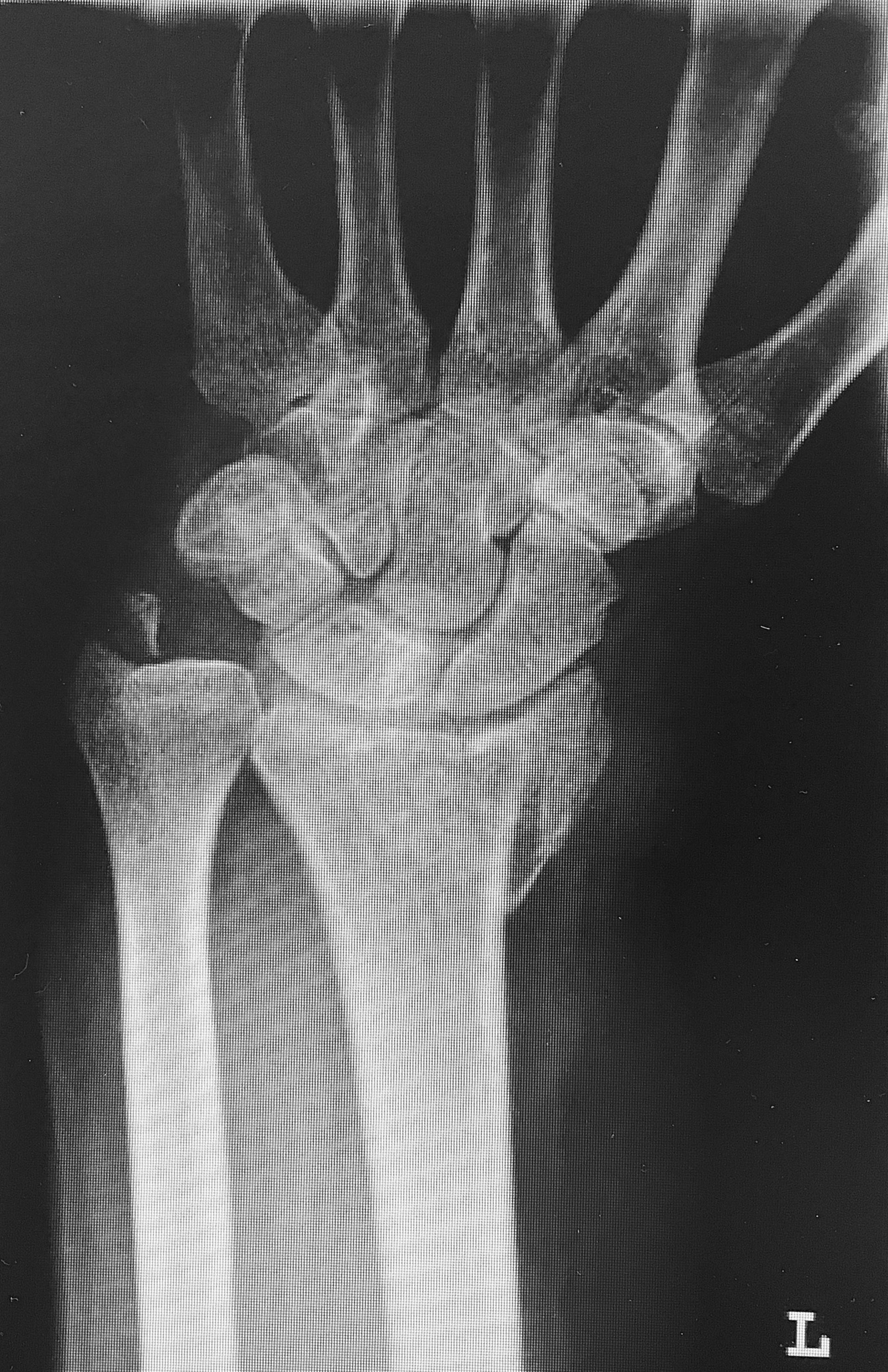 Röntgen des linken Handgelenkes mit Darstellung einer distalen Radiusfraktur