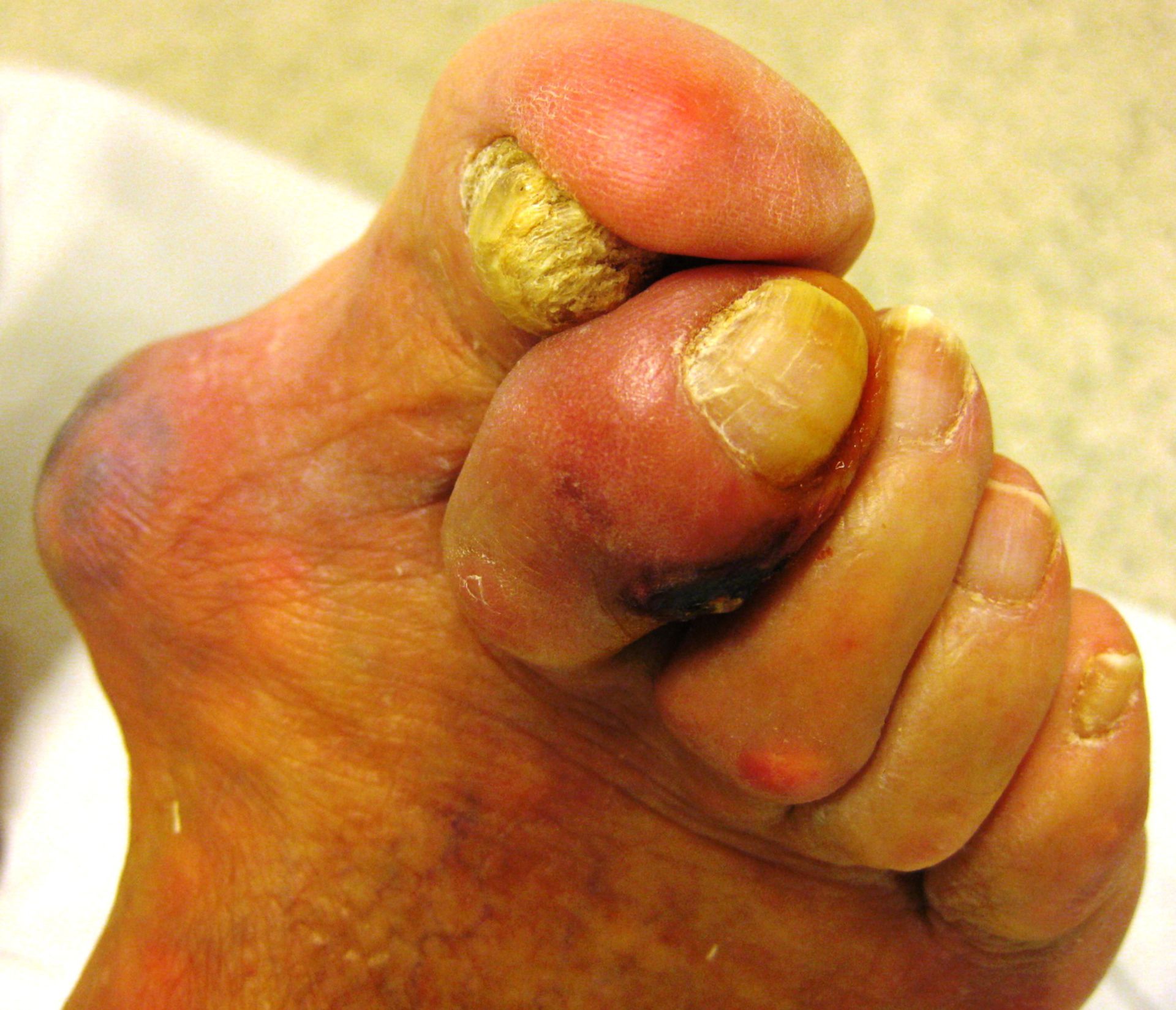 Diabetic foot and gout