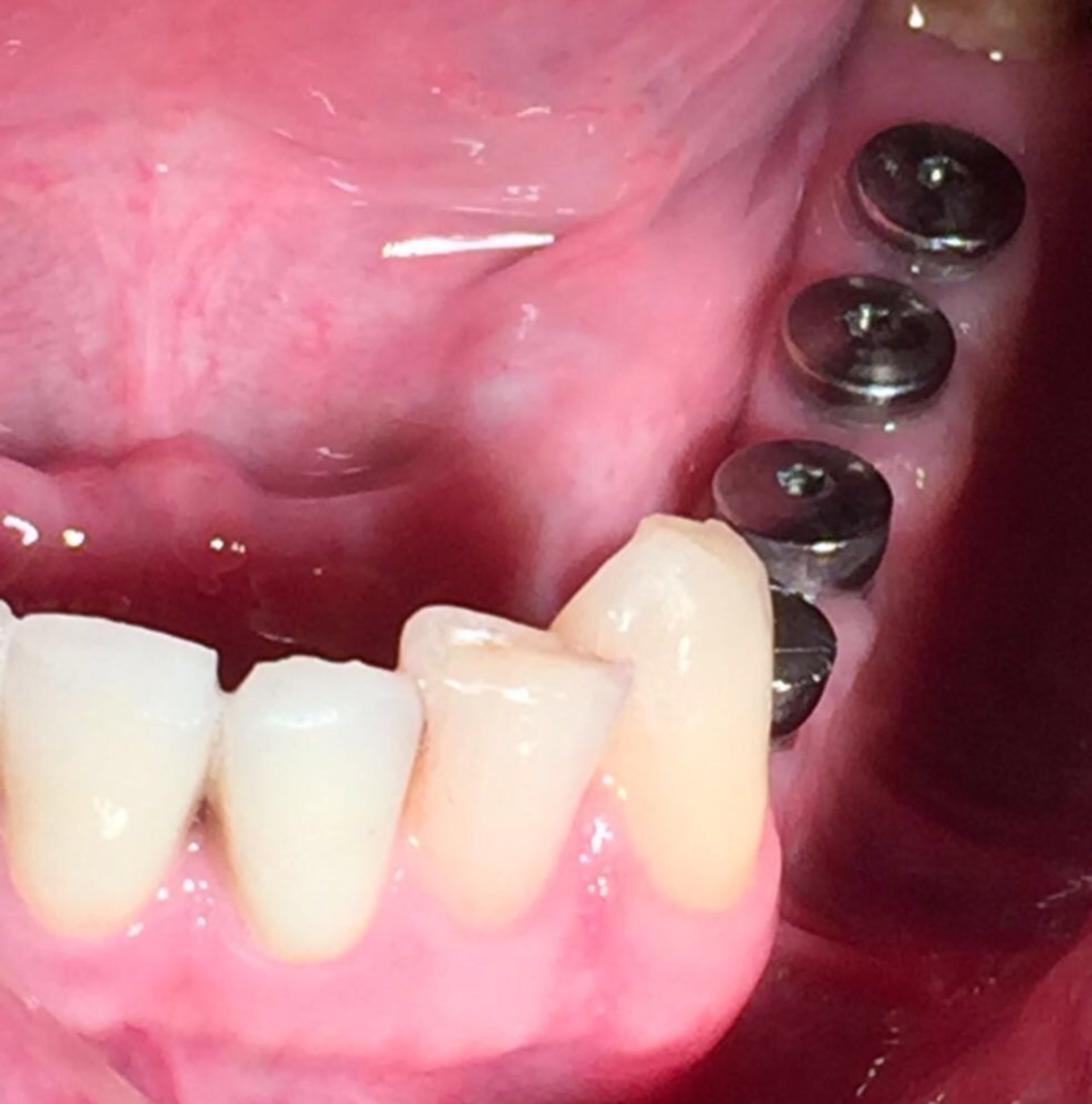 Vier Zahnimplantate im Unterkiefer