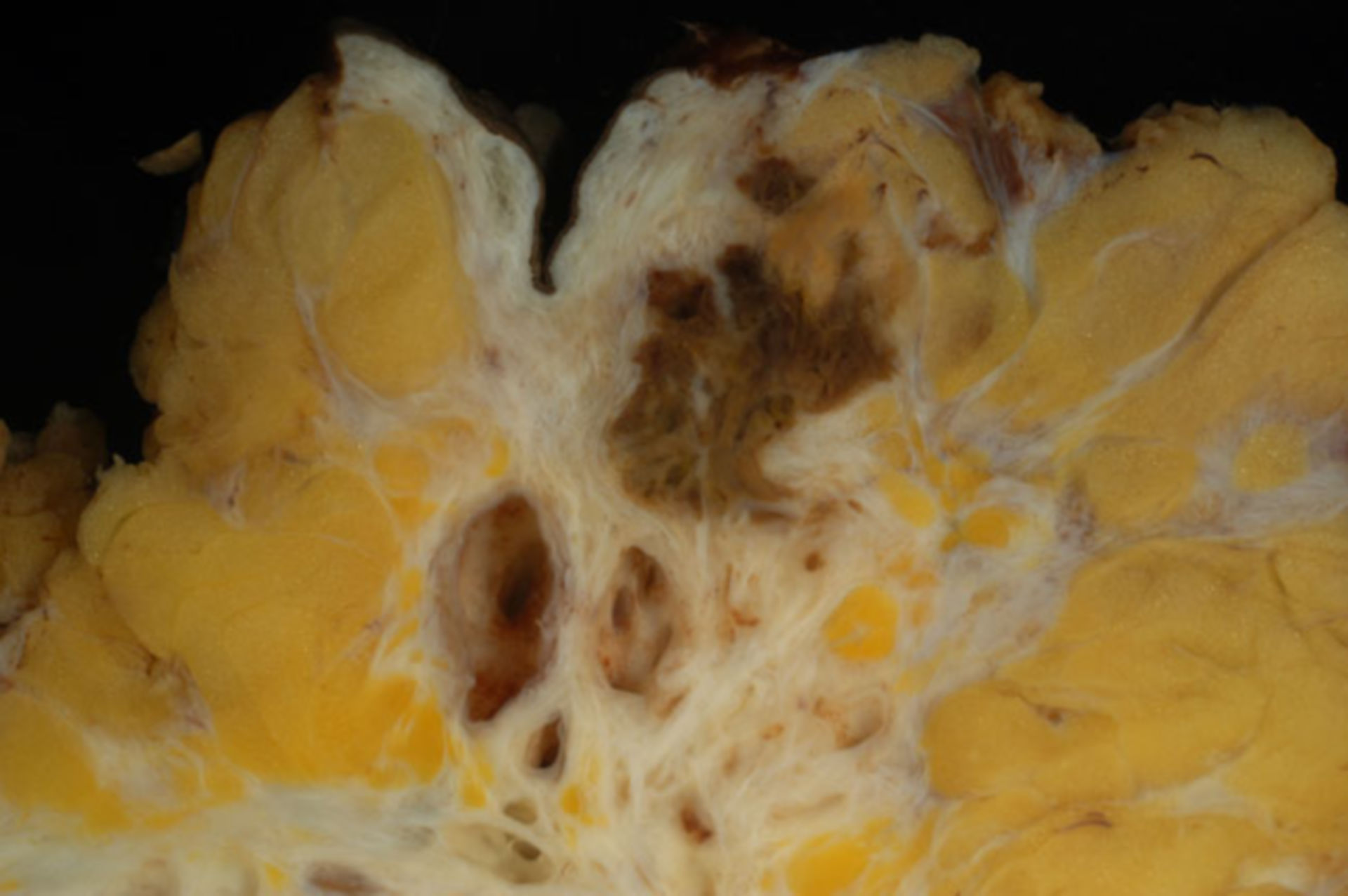 Endometriose (2)