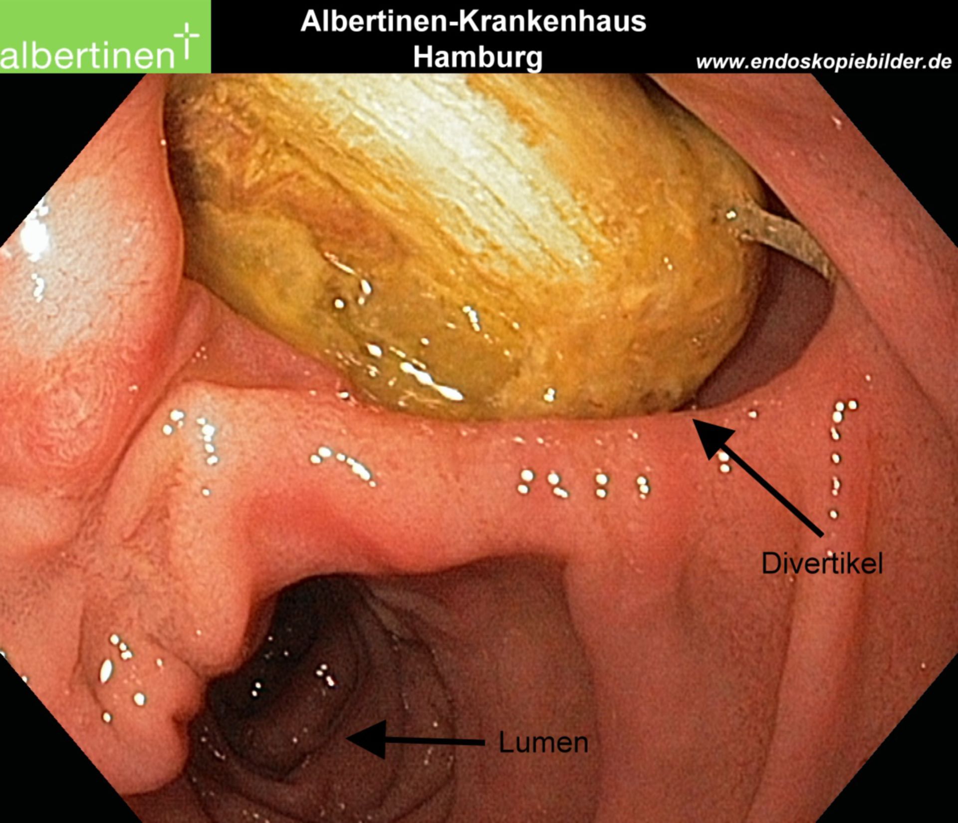 Duodenal-Divertikel mit Bezoar Endo Pfeile