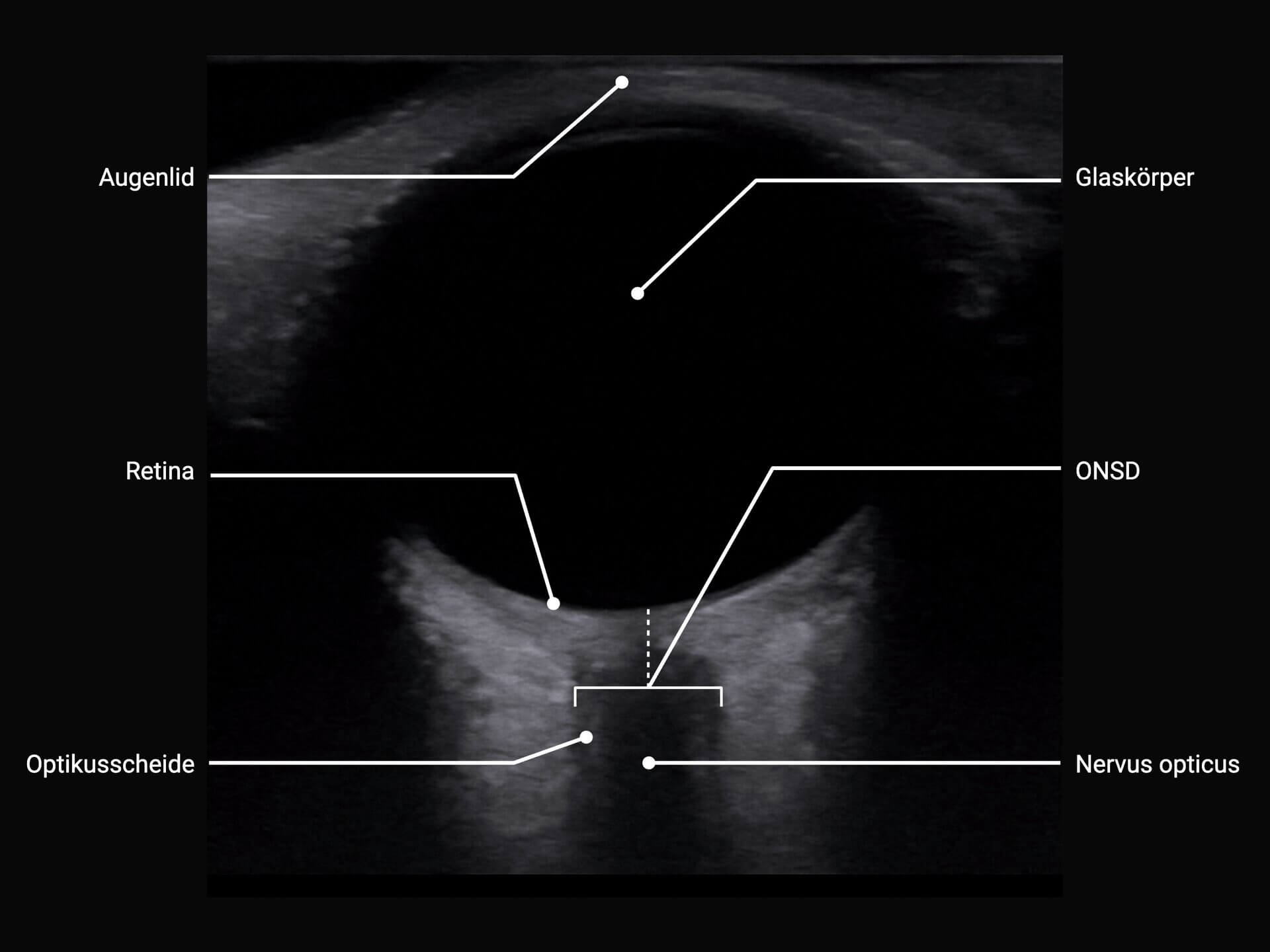 Optikusscheiden-Sonographie