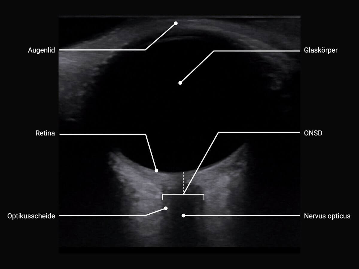 Optikusscheiden-Sonographie