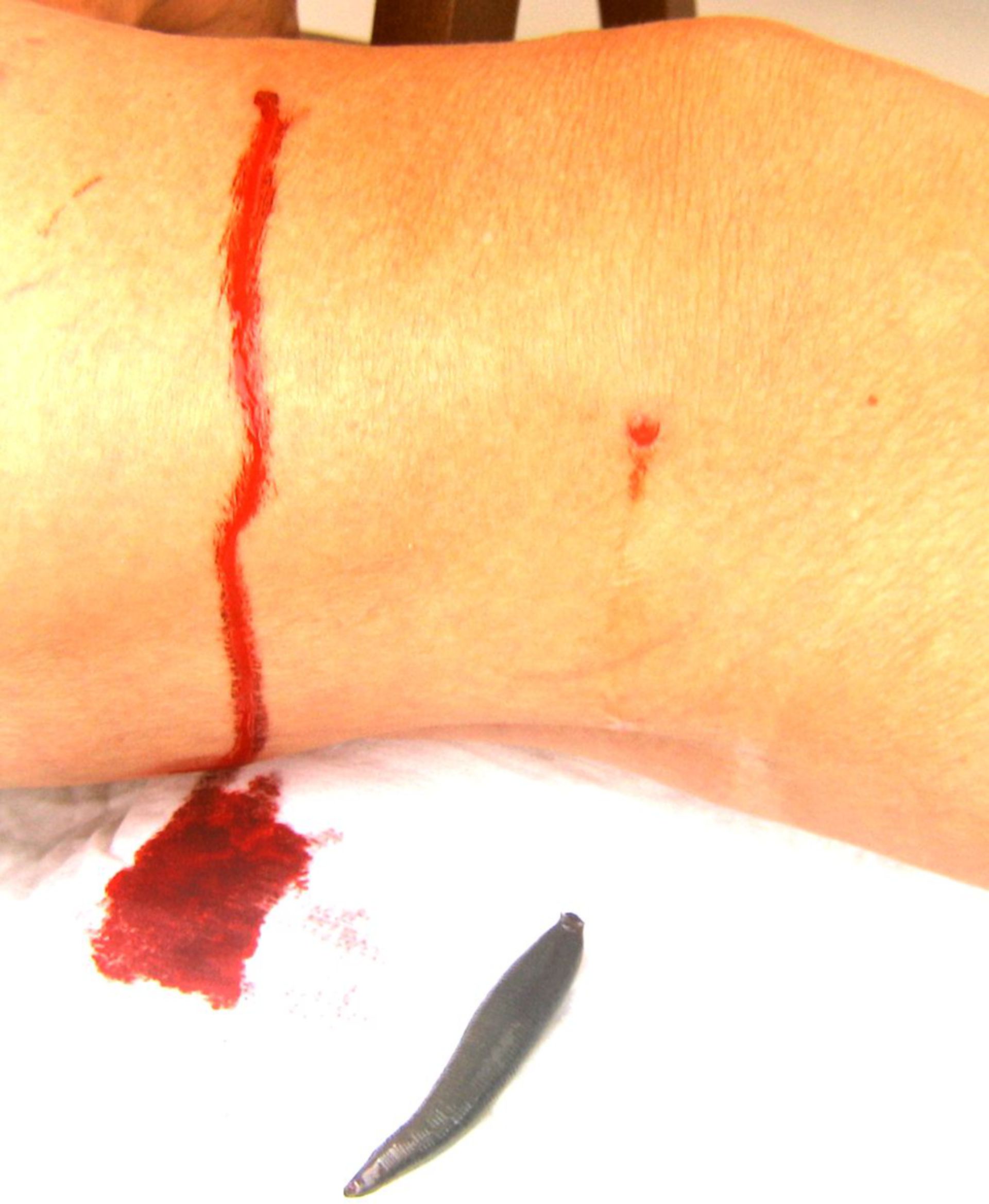 Blutegel an einem Knie