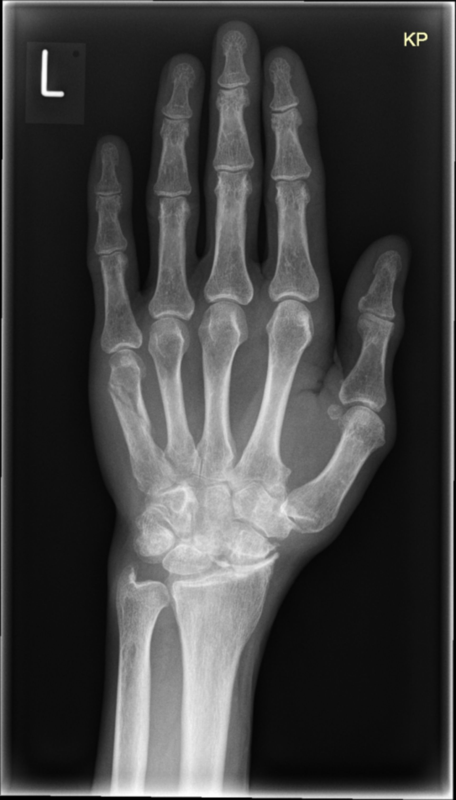 Deformierende Arthrose der Handwurzelknochen (rö_ap)