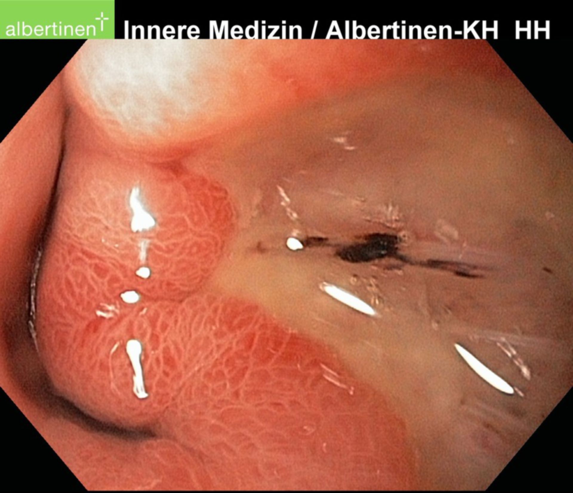 File duodenal ulcers