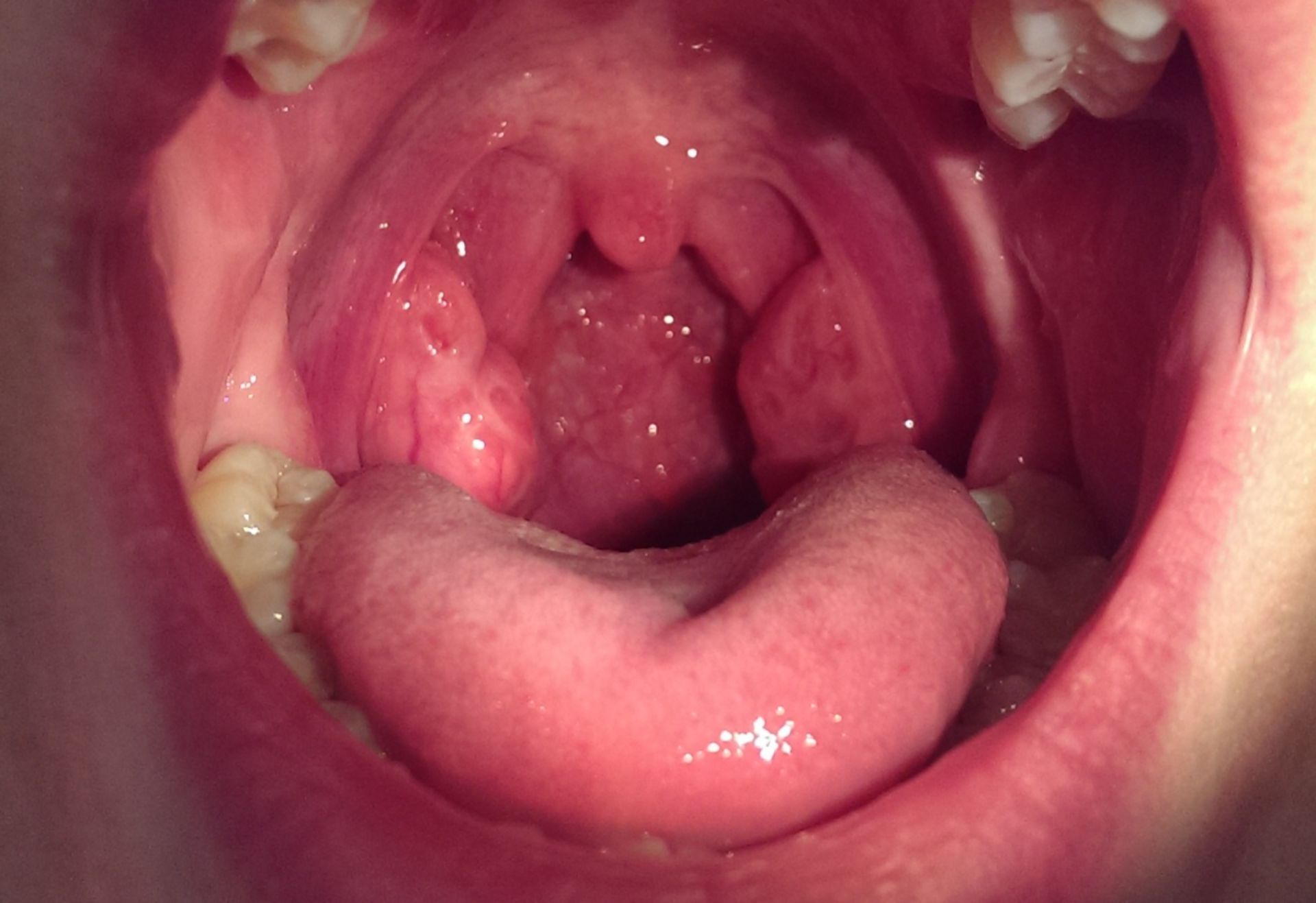 Hyperplasia of the tonsils