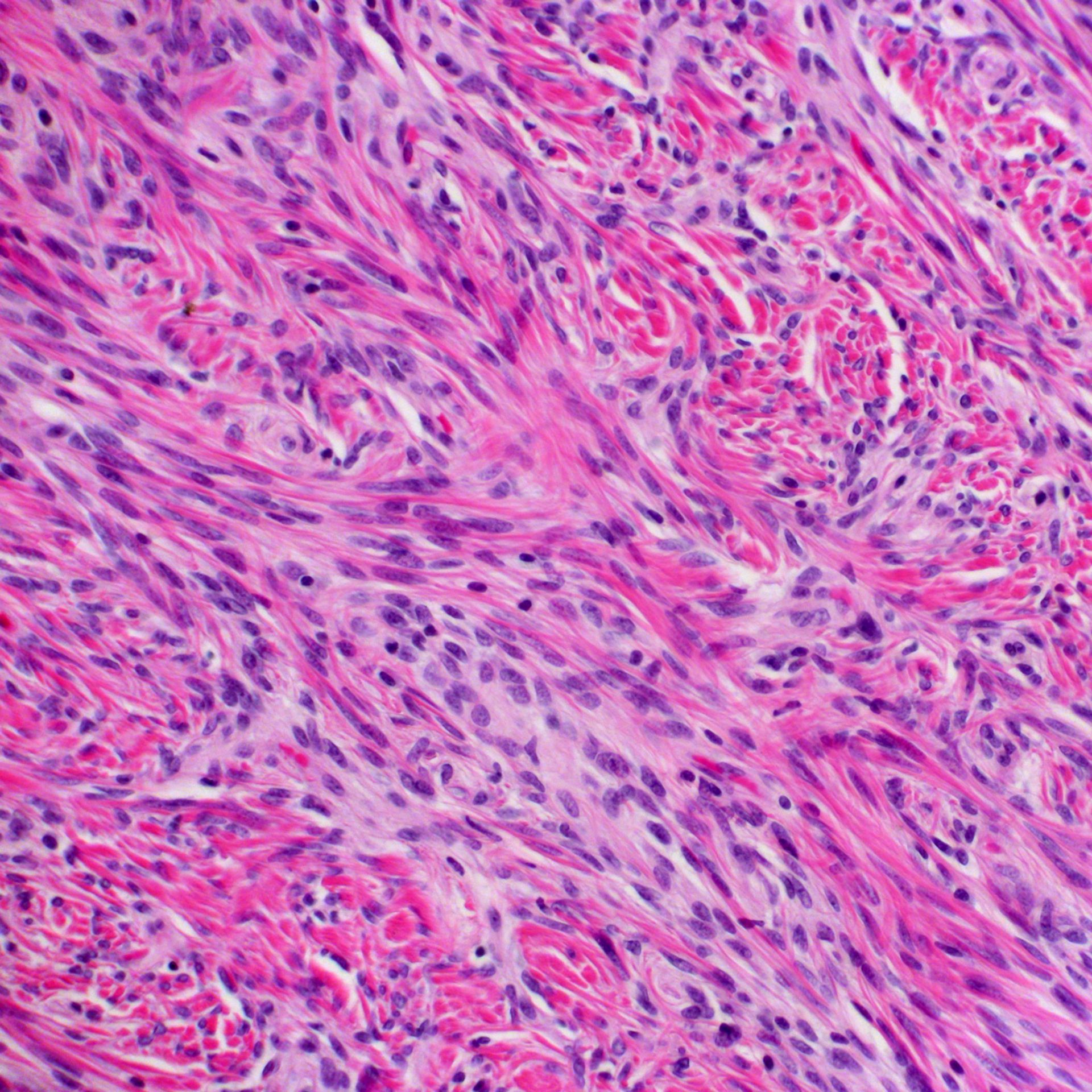 Solitärer fibröser Tumor (SFT)