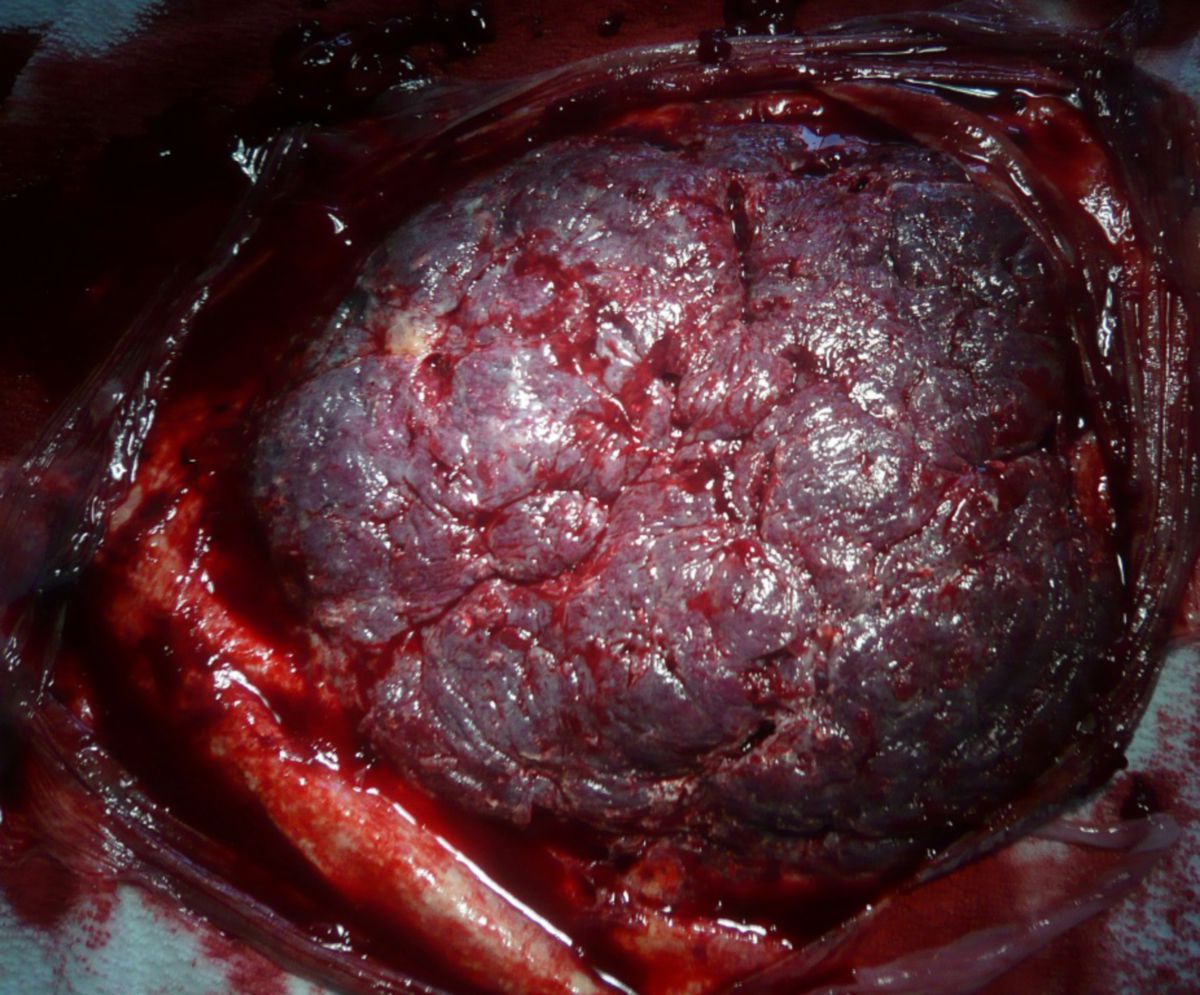 Placenta - von mütterlicher Seite