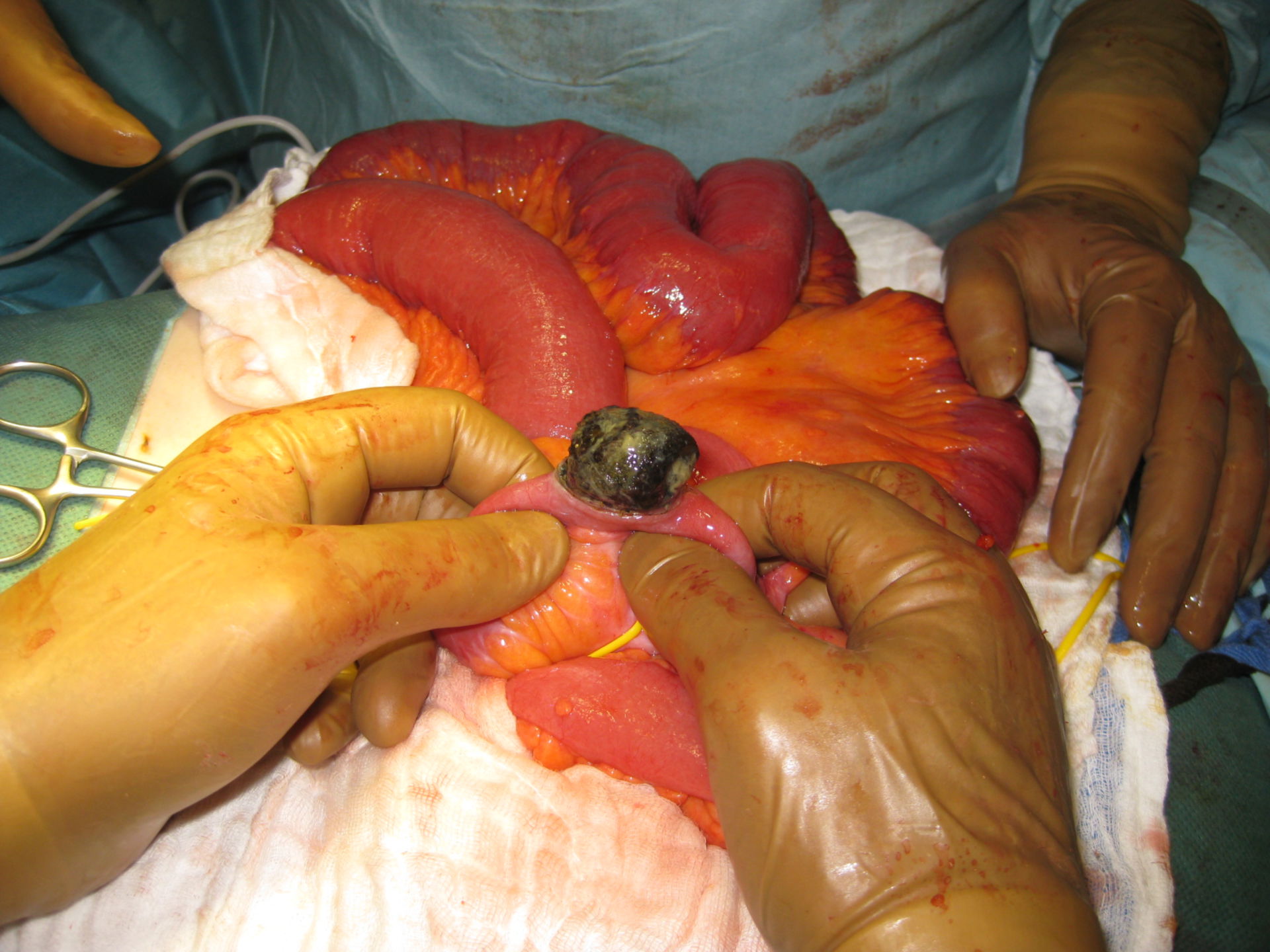 Obstrucción intestinal debido a piedras en la vesícula