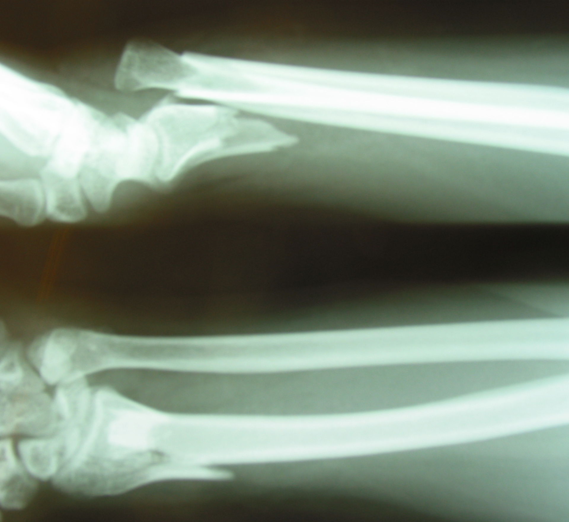 Galeazzi fracture, X-ray