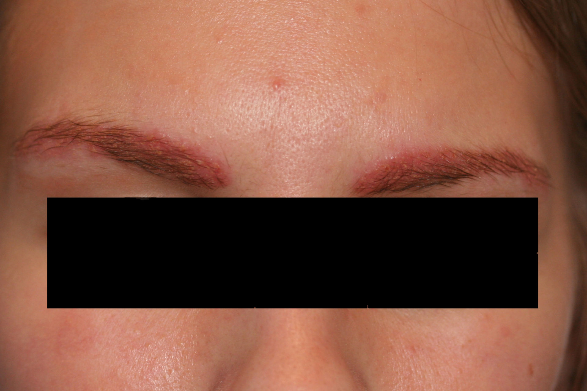 Kontaktallergie auf Semi--permantes Makeup (Eyebrow)