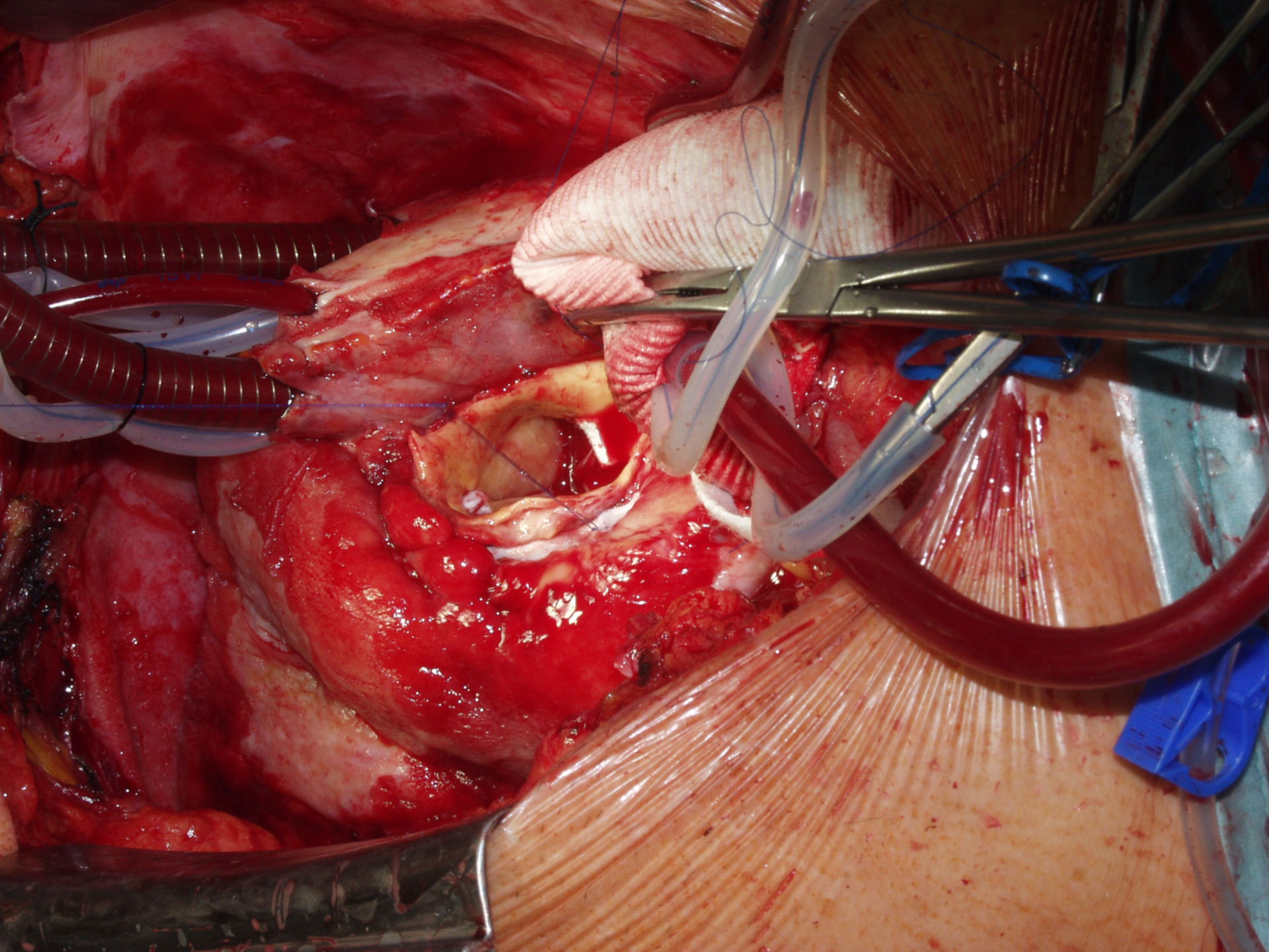 Aneurisma de aorta (2d)
