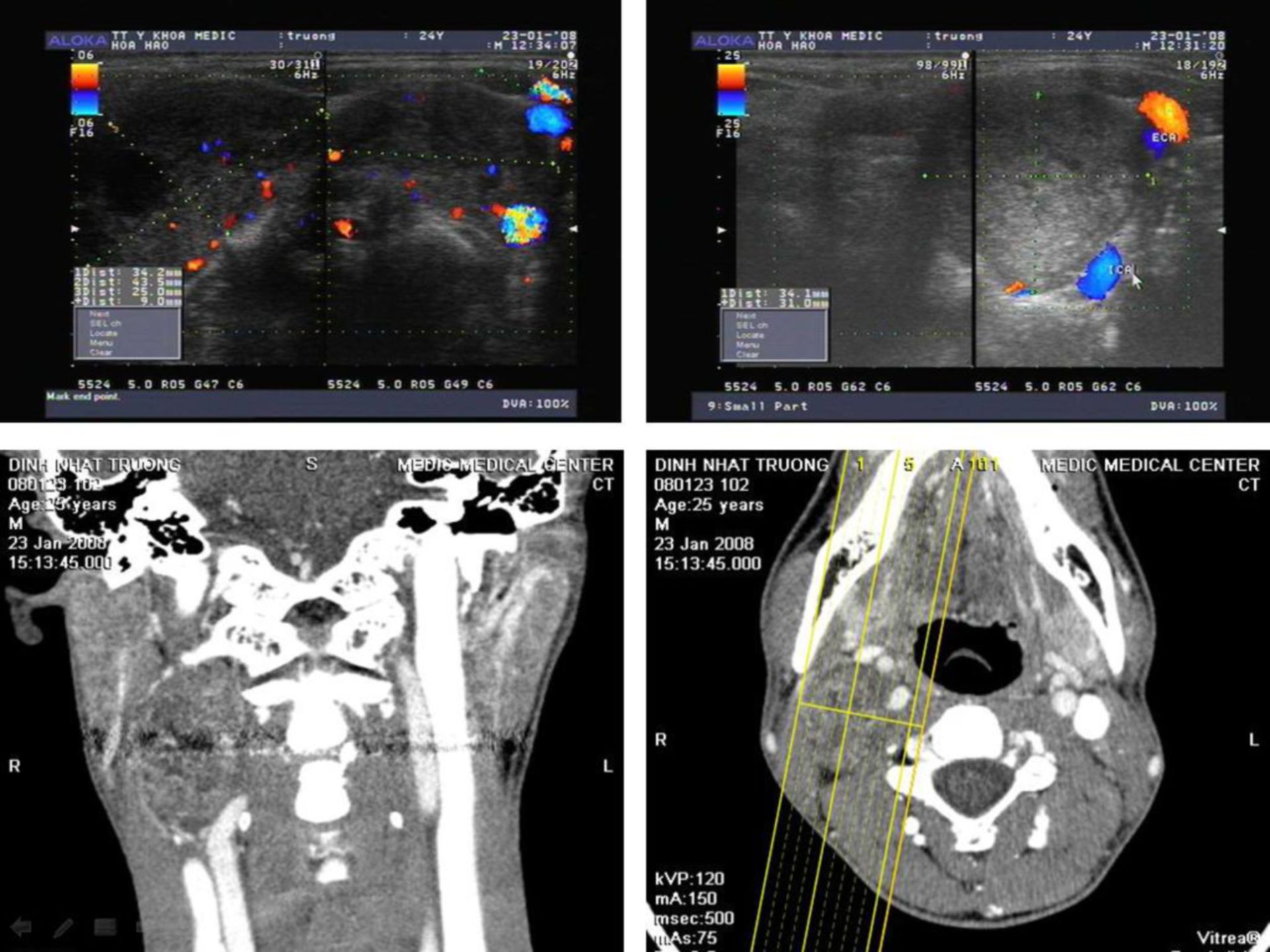 Glomus caroticum-Tumor