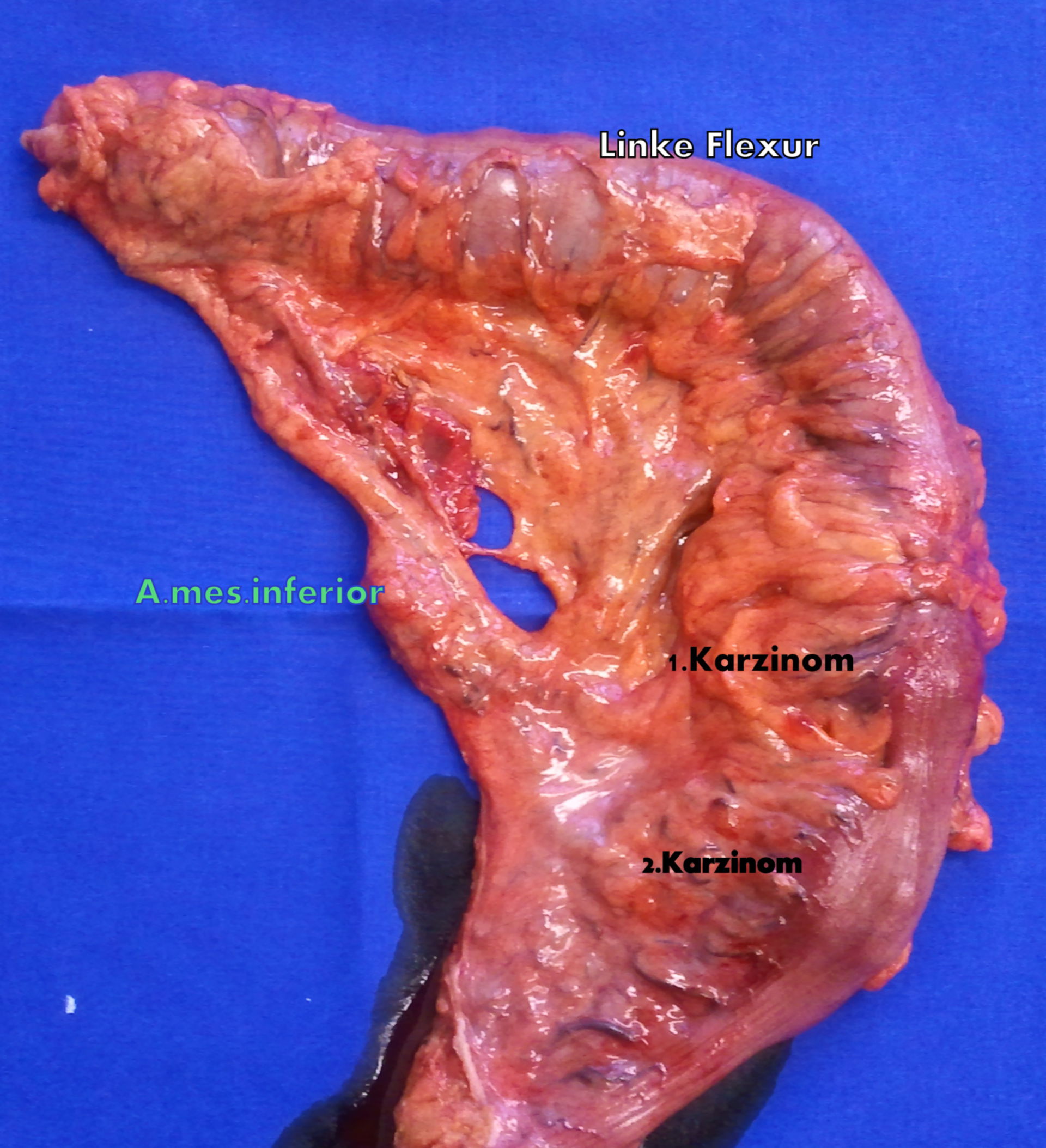 Two synchronous cancers of the sigmoid colon - specimen not sliced
