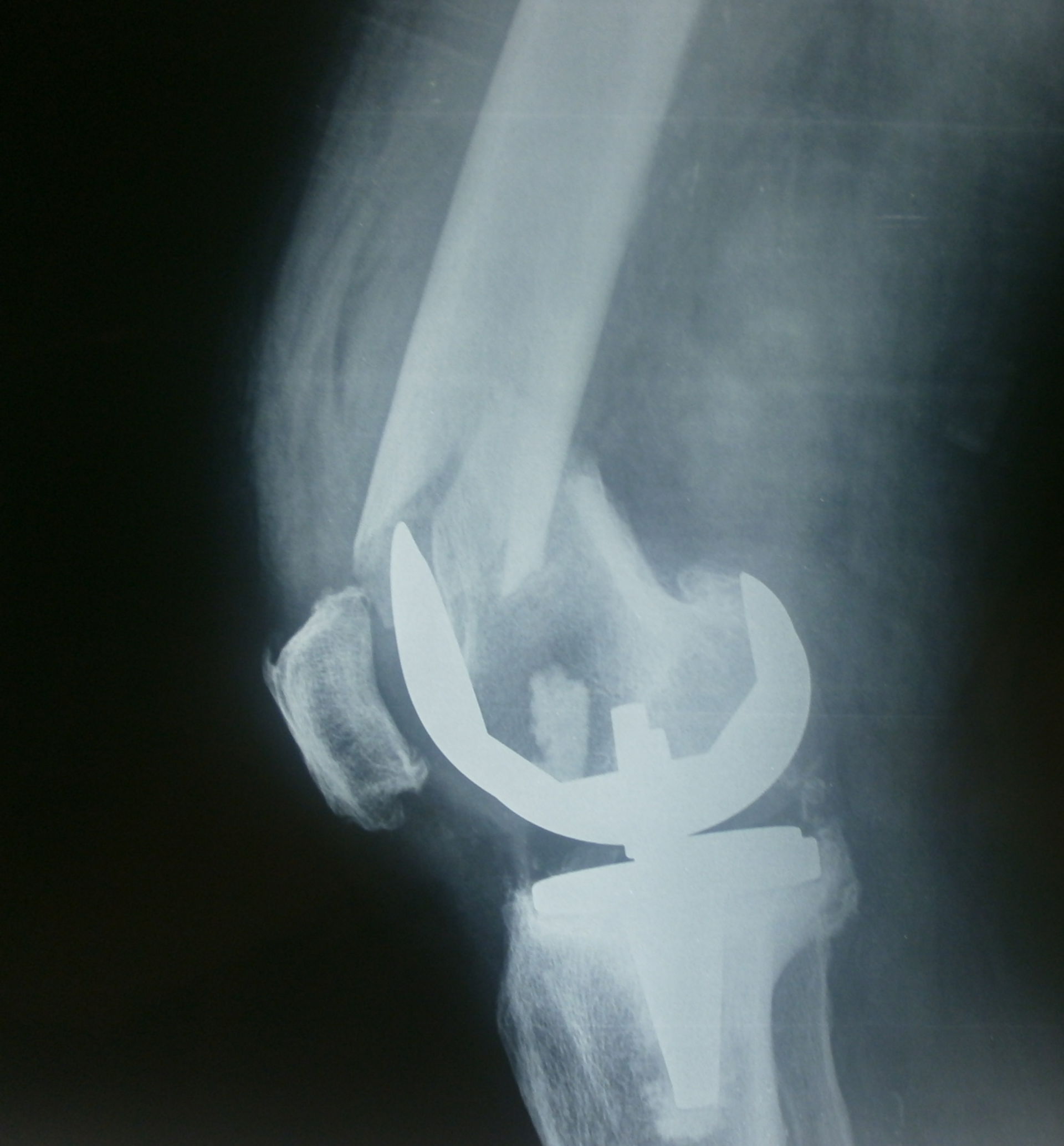 Periprosthetic fracture knee