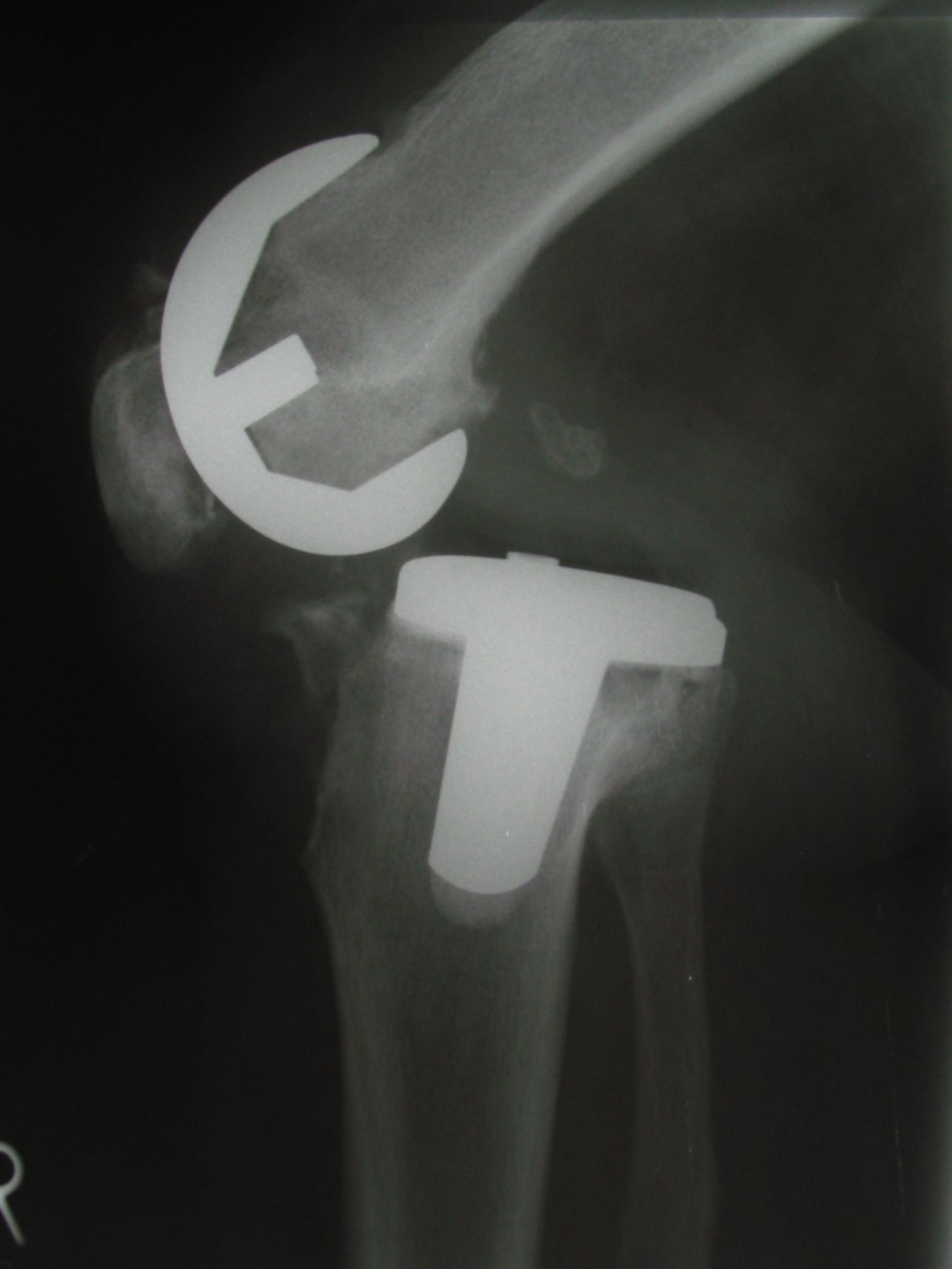Luxated knee TEP (Surface implant)