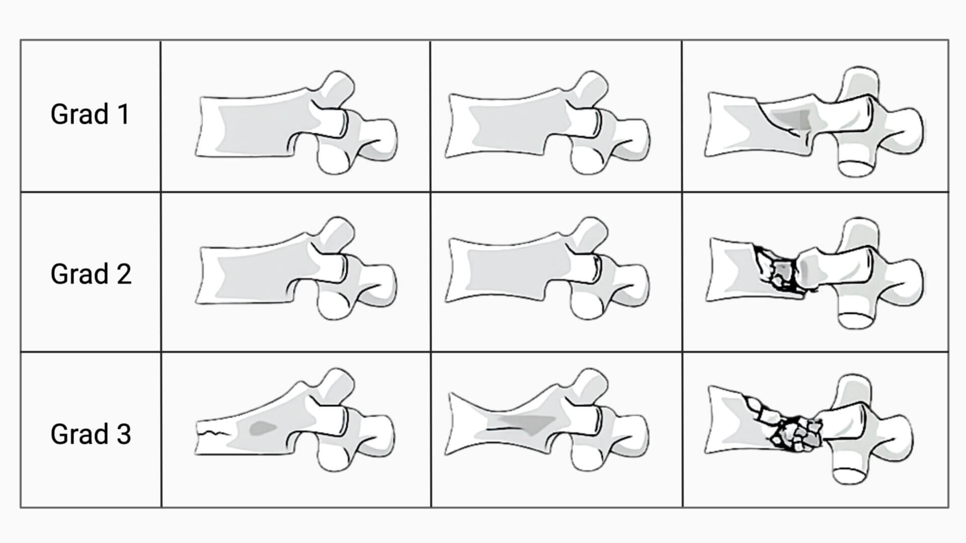 Genant-Klassifikation