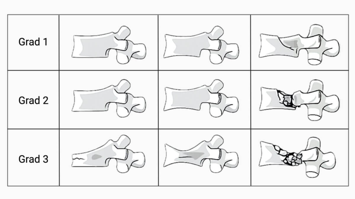 Genant-Klassifikation
