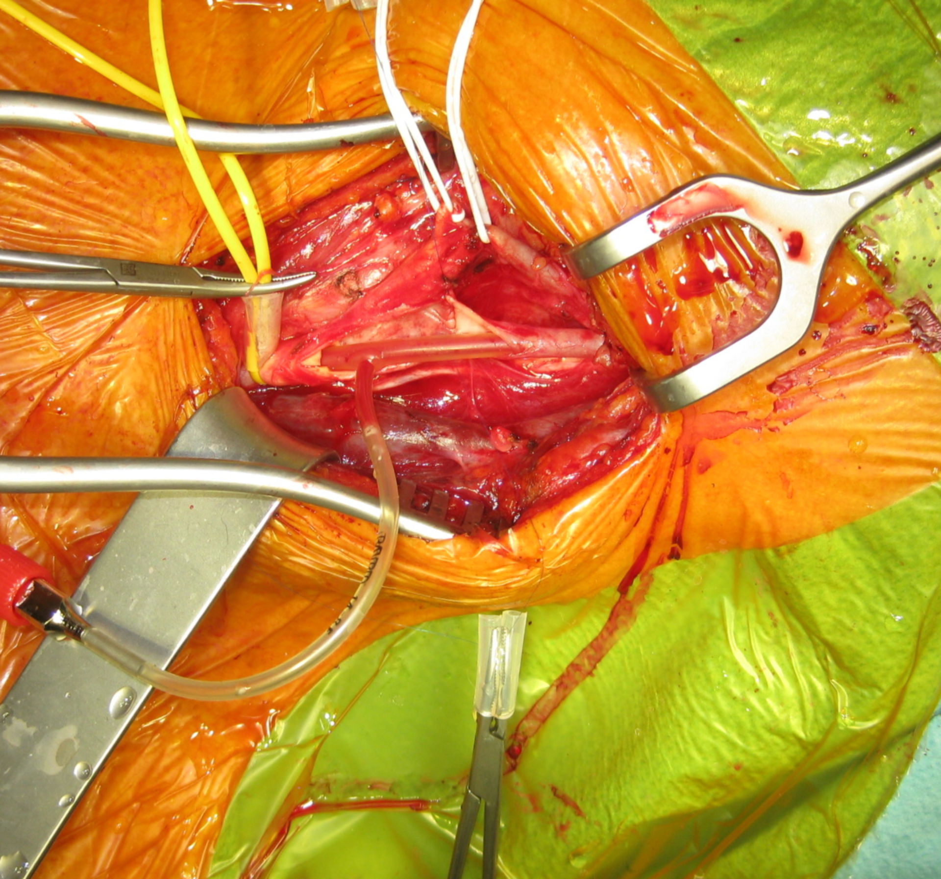 Carotis TEA - intima stepping suture
