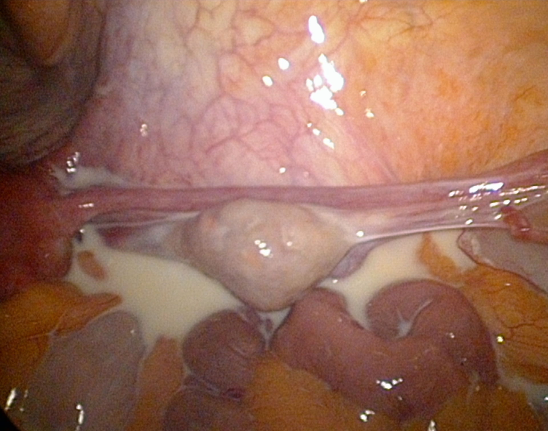 Enzündung des Pankreas
