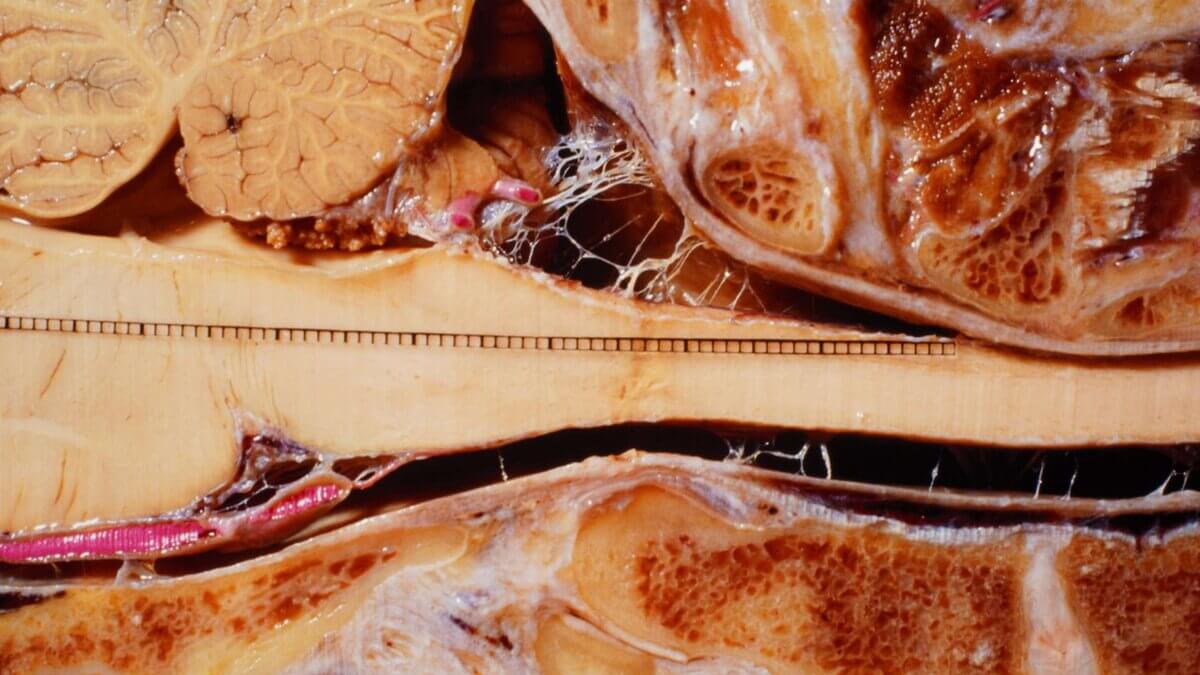 Sagittalschnitt des Hirnstamms