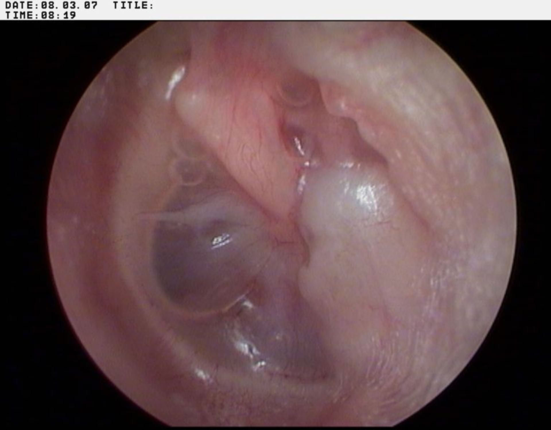 Massively retracted tympanic membrane with middle ear effusion on the left