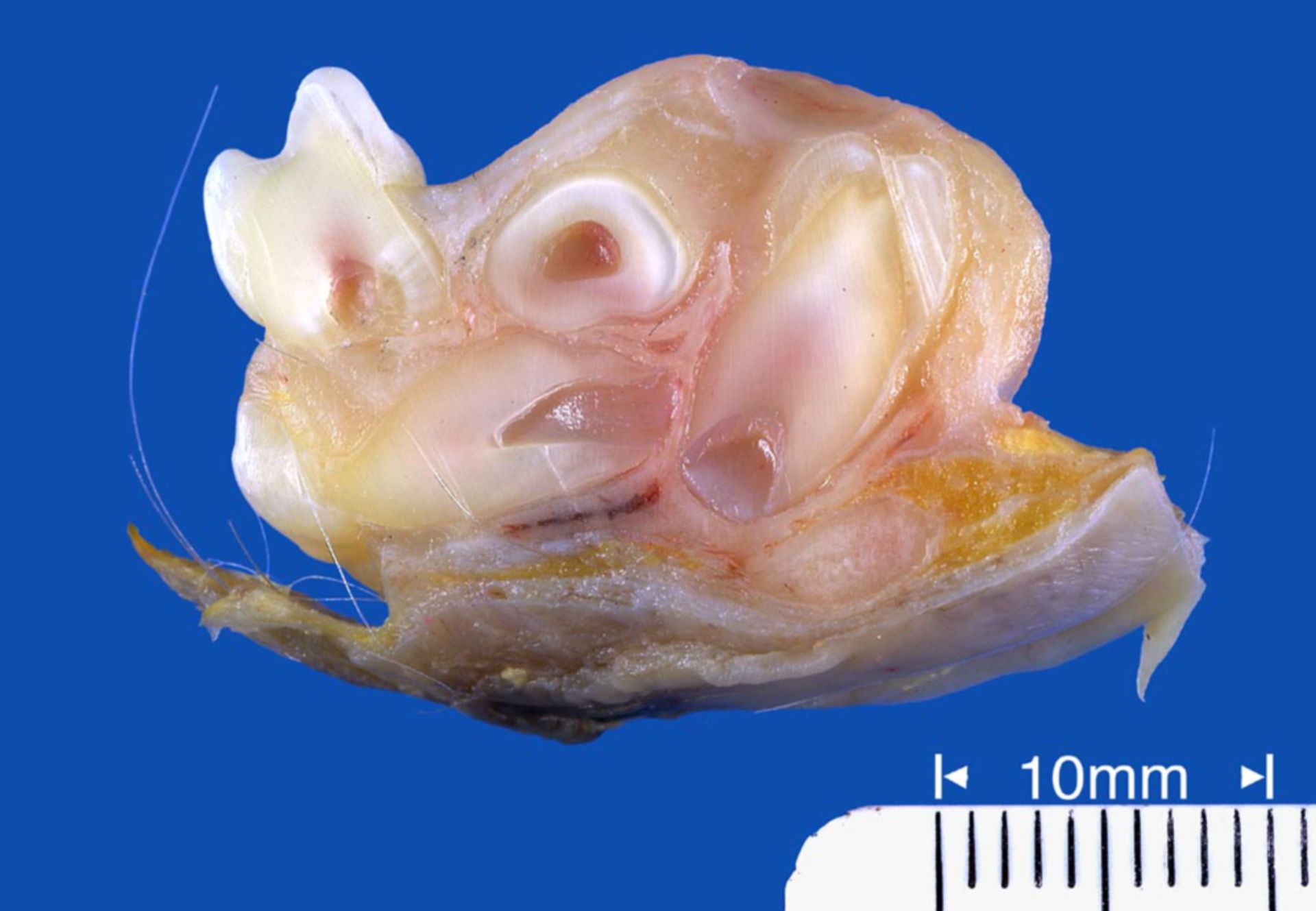 Teratoma maduro benigno de ovario (1)