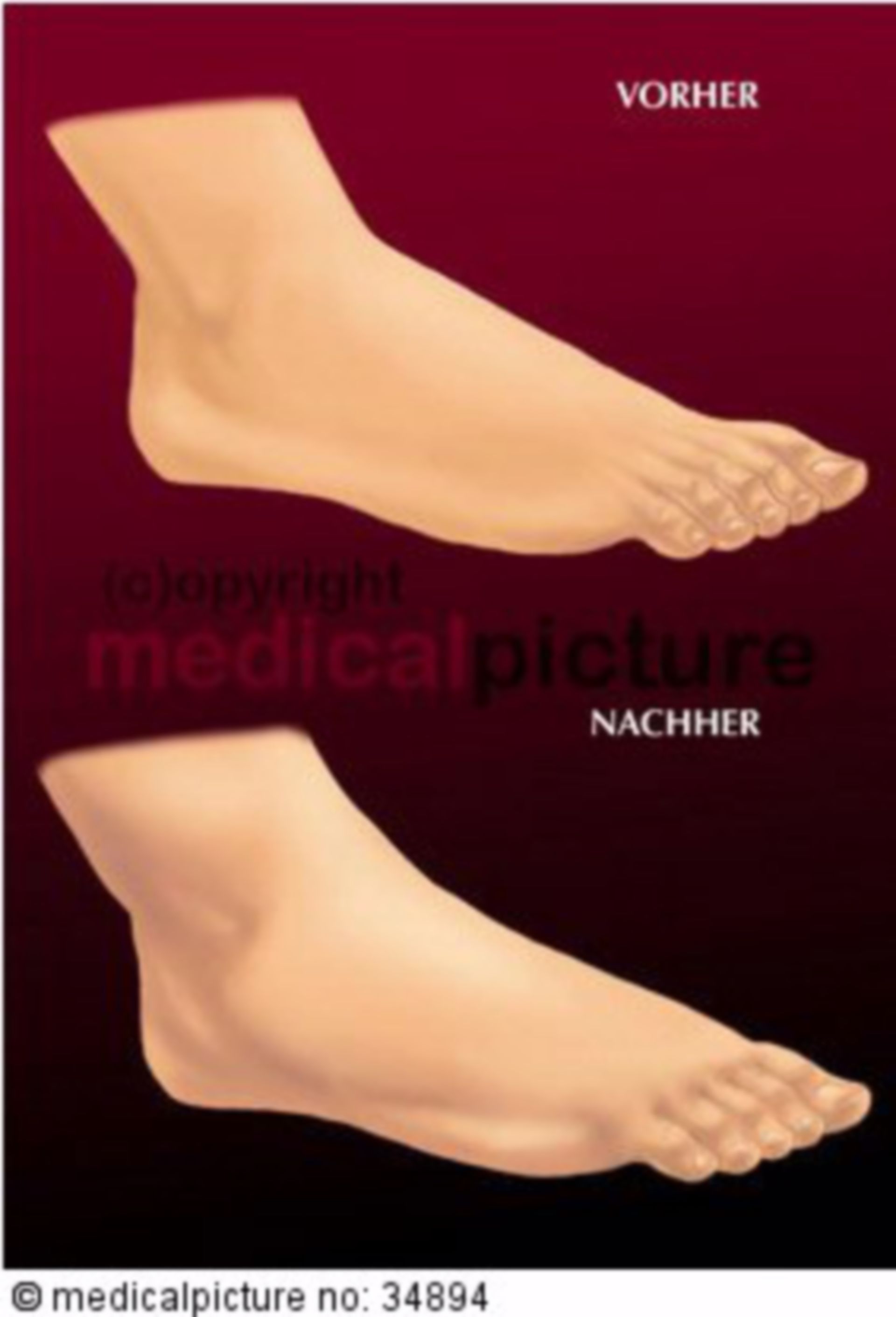 Edema of the foot